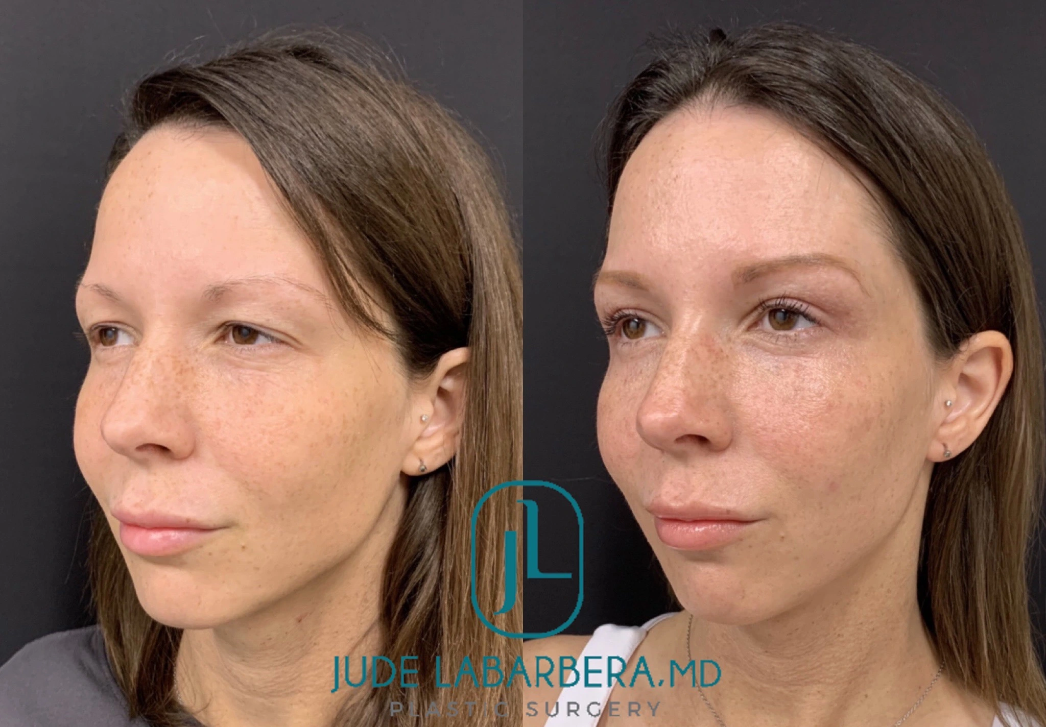 Upper EYELID Lift Before & After Case Number 00015
