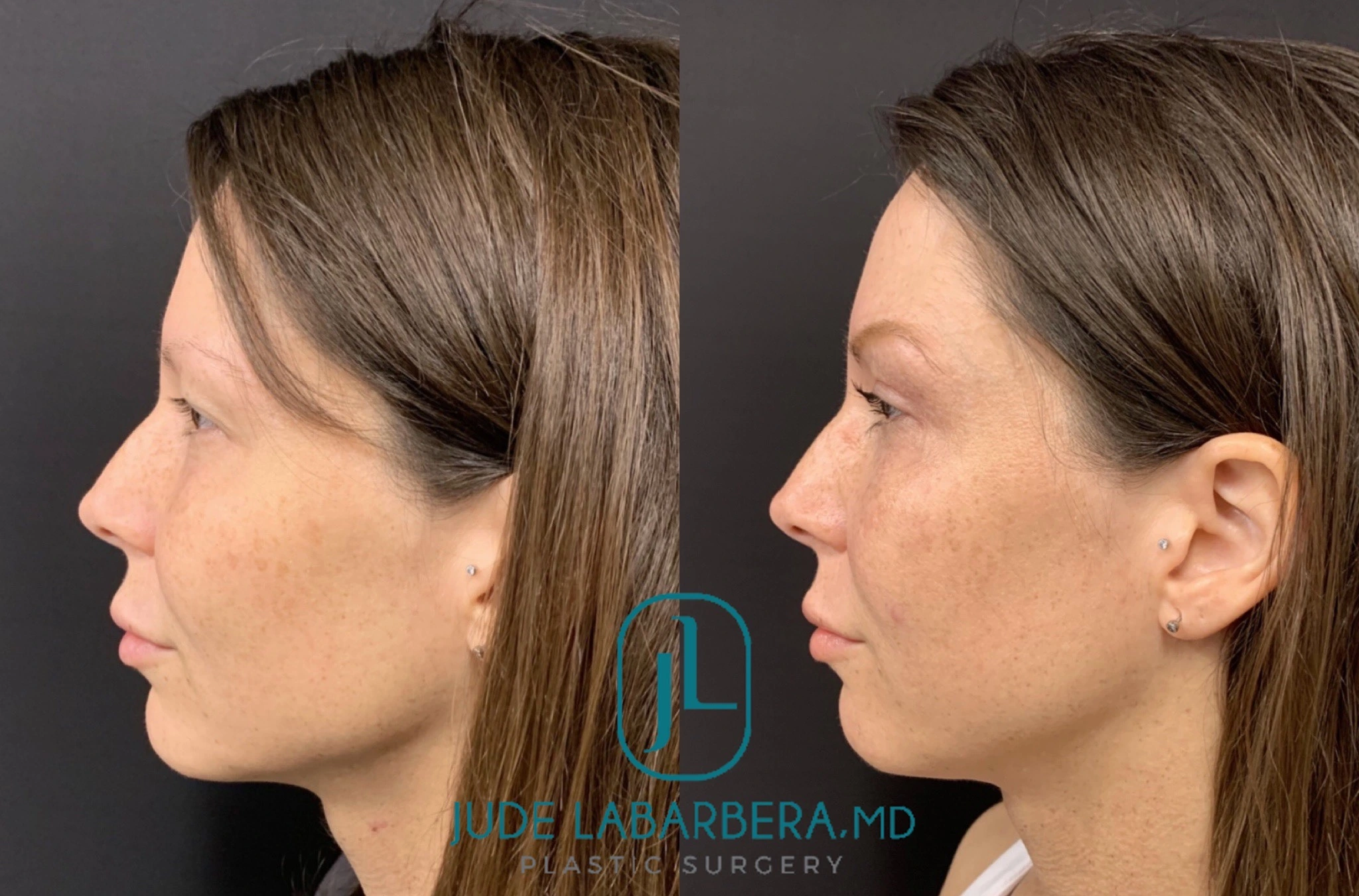Upper EYELID Lift Before & After Case Number 00015
