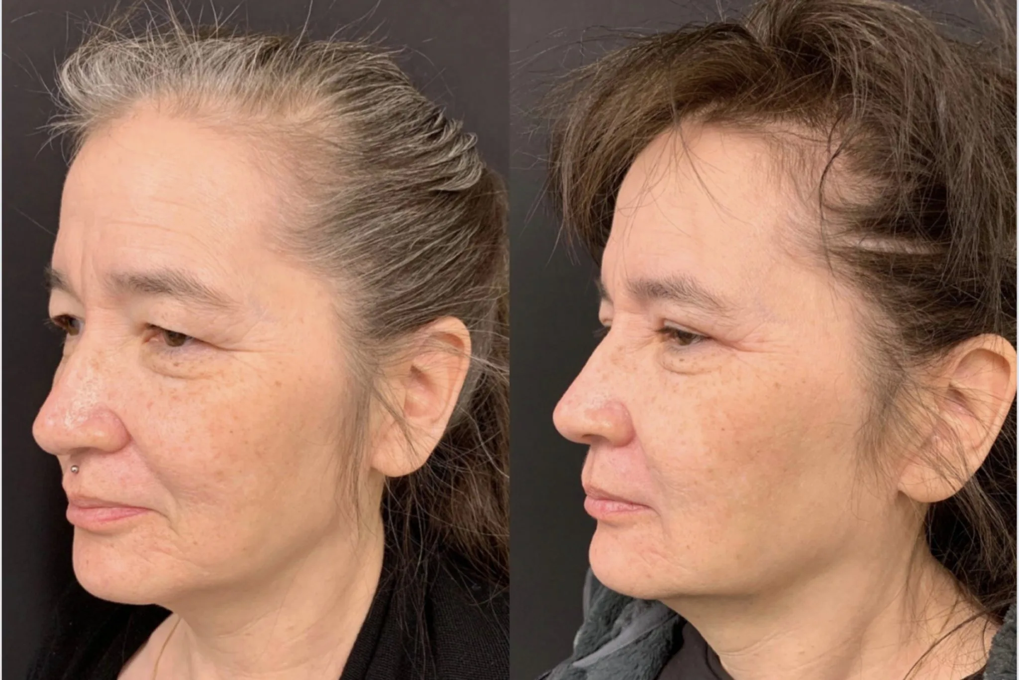 UPPER EYELID LIFT Before & After Case Number 0004