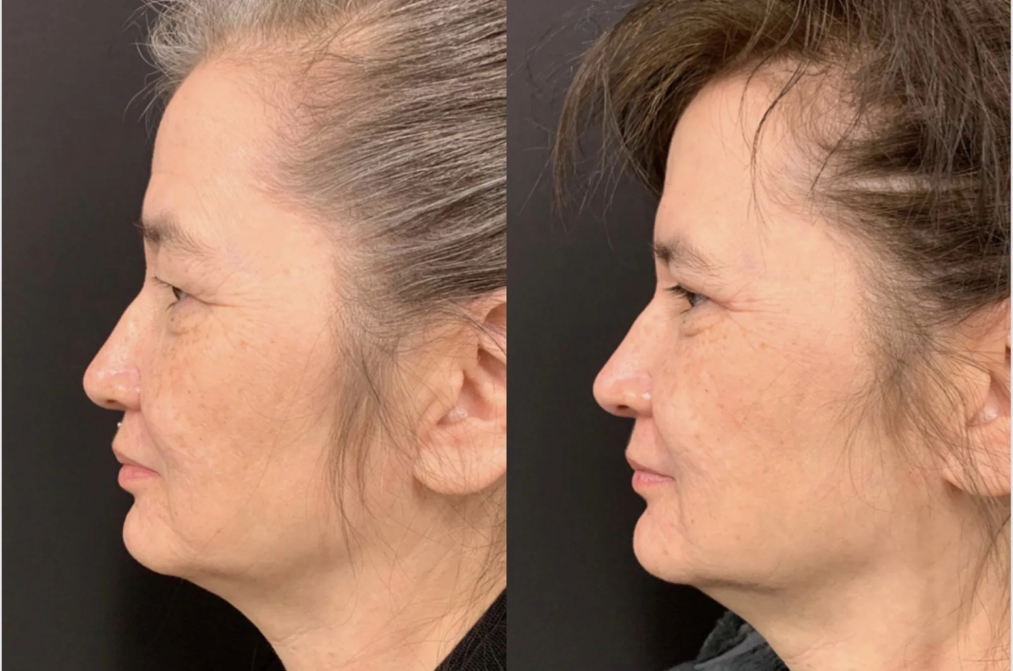 UPPER EYELID LIFT Before & After Case Number 0004