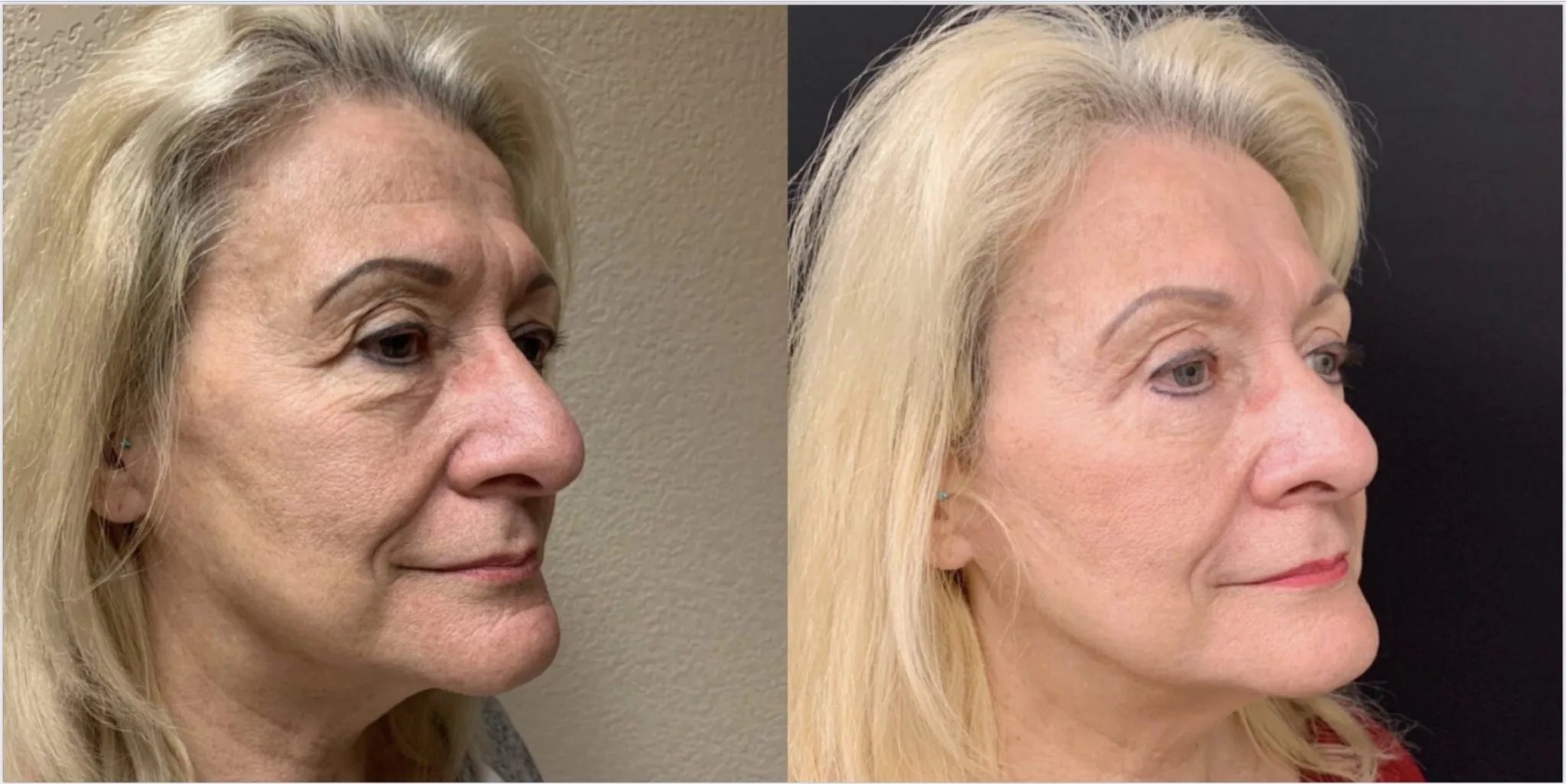 UPPER EYELID LIFT BY ANOTHER SURGEON ALONG WITH LOWER EYELID LIFT (BLEPHAROPLASTY) Before & After Case Number 0006