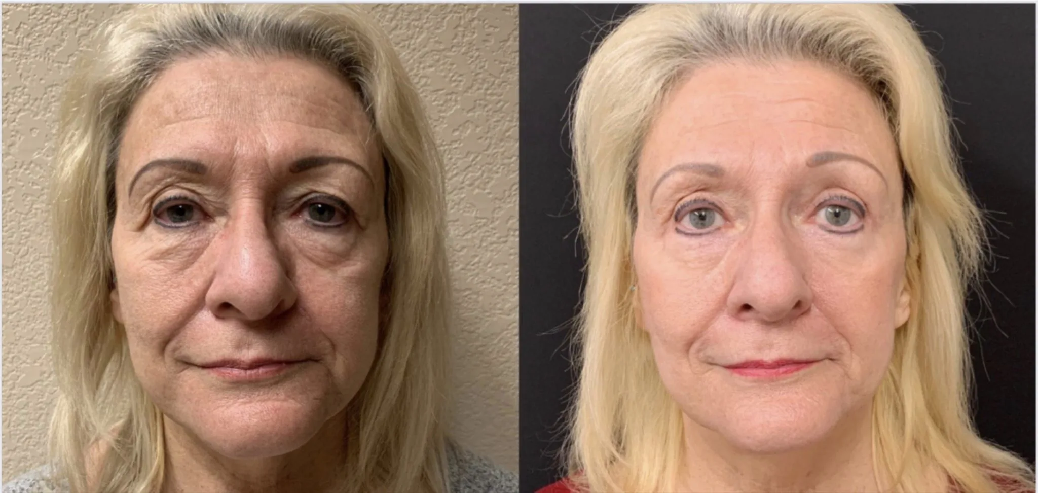 UPPER EYELID LIFT BY ANOTHER SURGEON ALONG WITH LOWER EYELID LIFT (BLEPHAROPLASTY) Before & After Case Number 0006