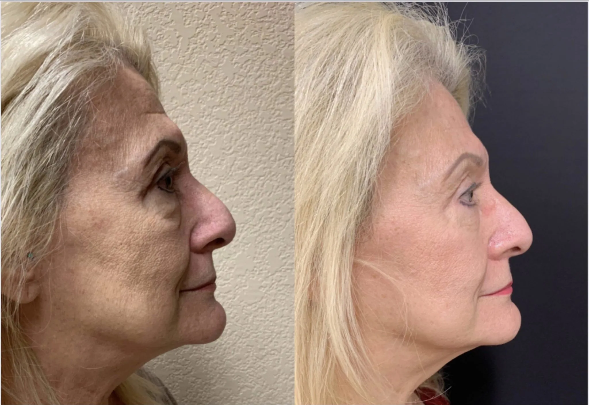 UPPER EYELID LIFT BY ANOTHER SURGEON ALONG WITH LOWER EYELID LIFT (BLEPHAROPLASTY) Before & After Case Number 0006