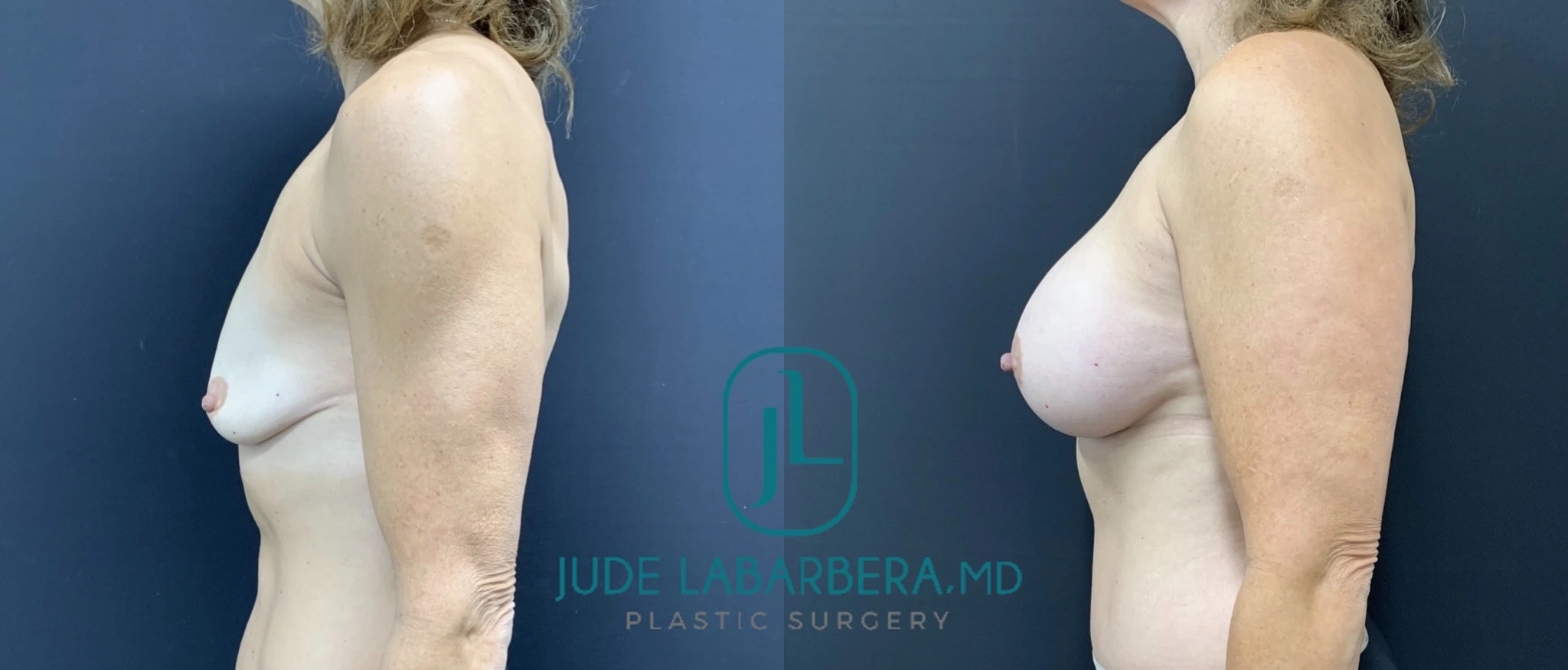 Breast Augmentation Before & After Case Number 00075