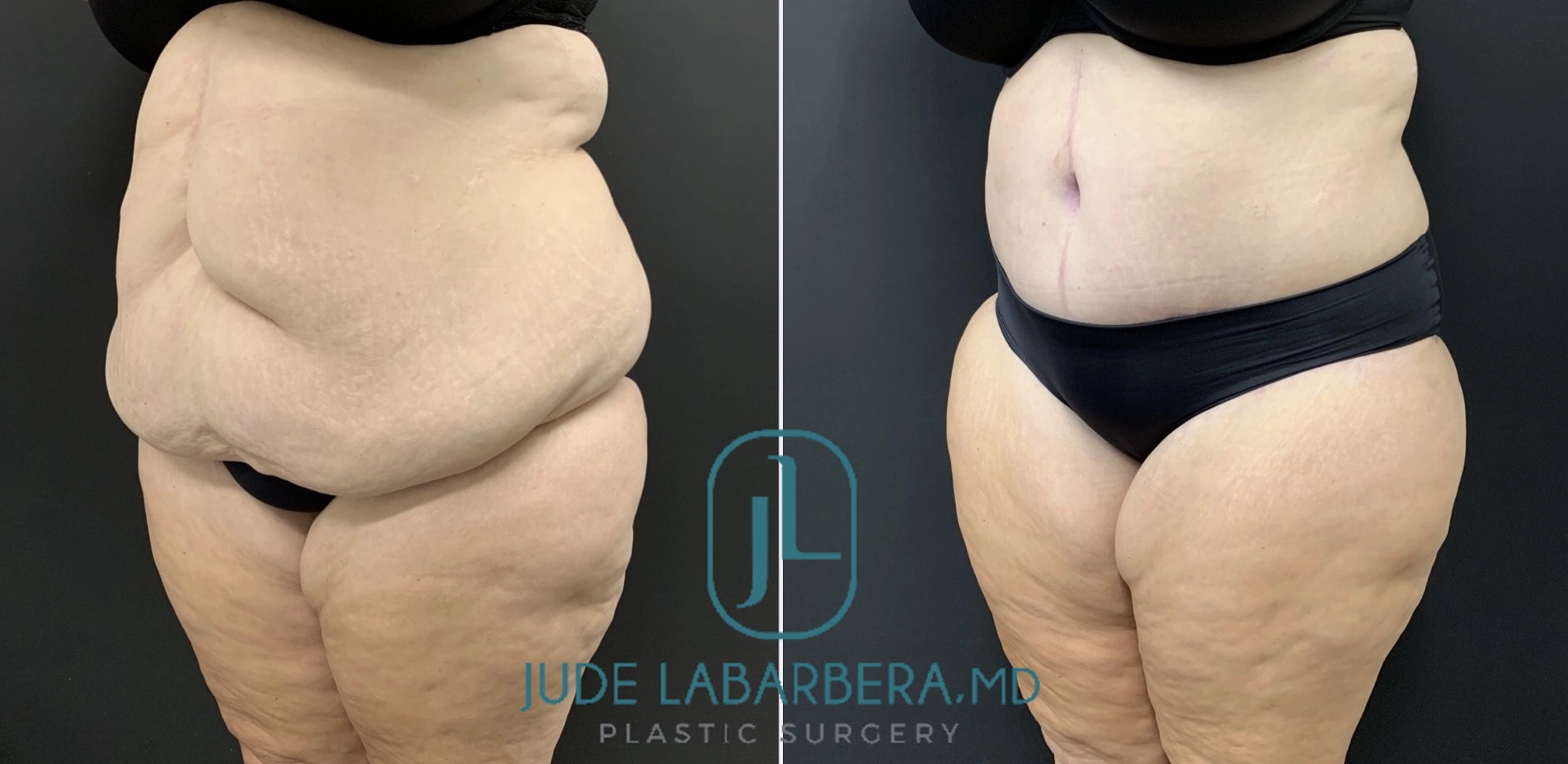 High-BMI Tummy Tuck Before & After Case Number 000117