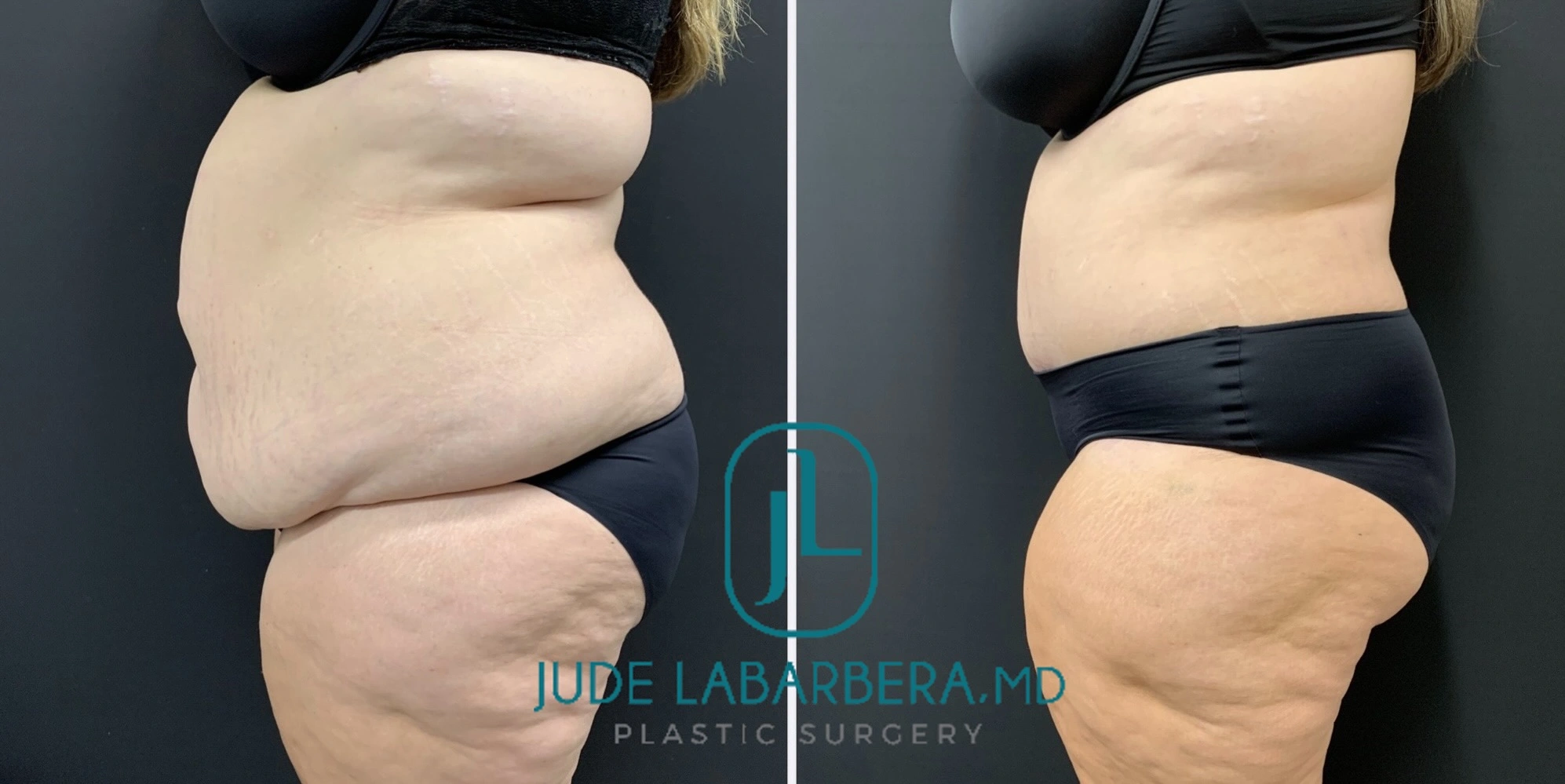 High-BMI Tummy Tuck Before & After Case Number 000117
