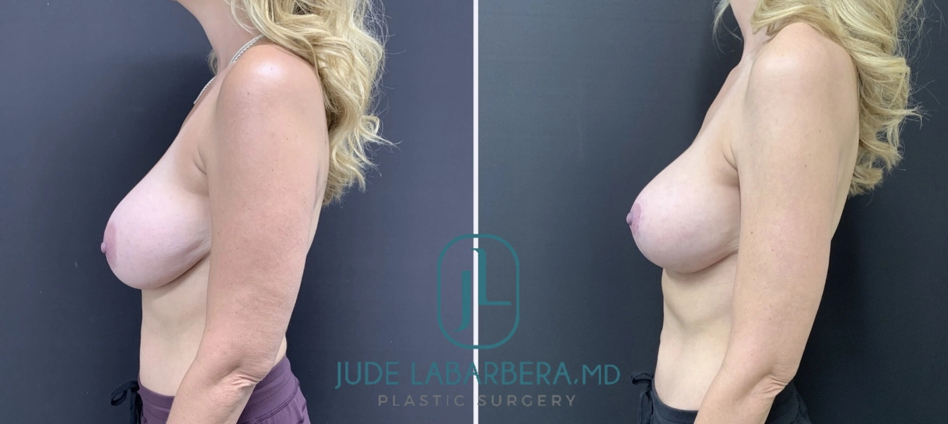 Long Term Results Breast Aug with Lift & Breast Revision Before & After Case Number 00074