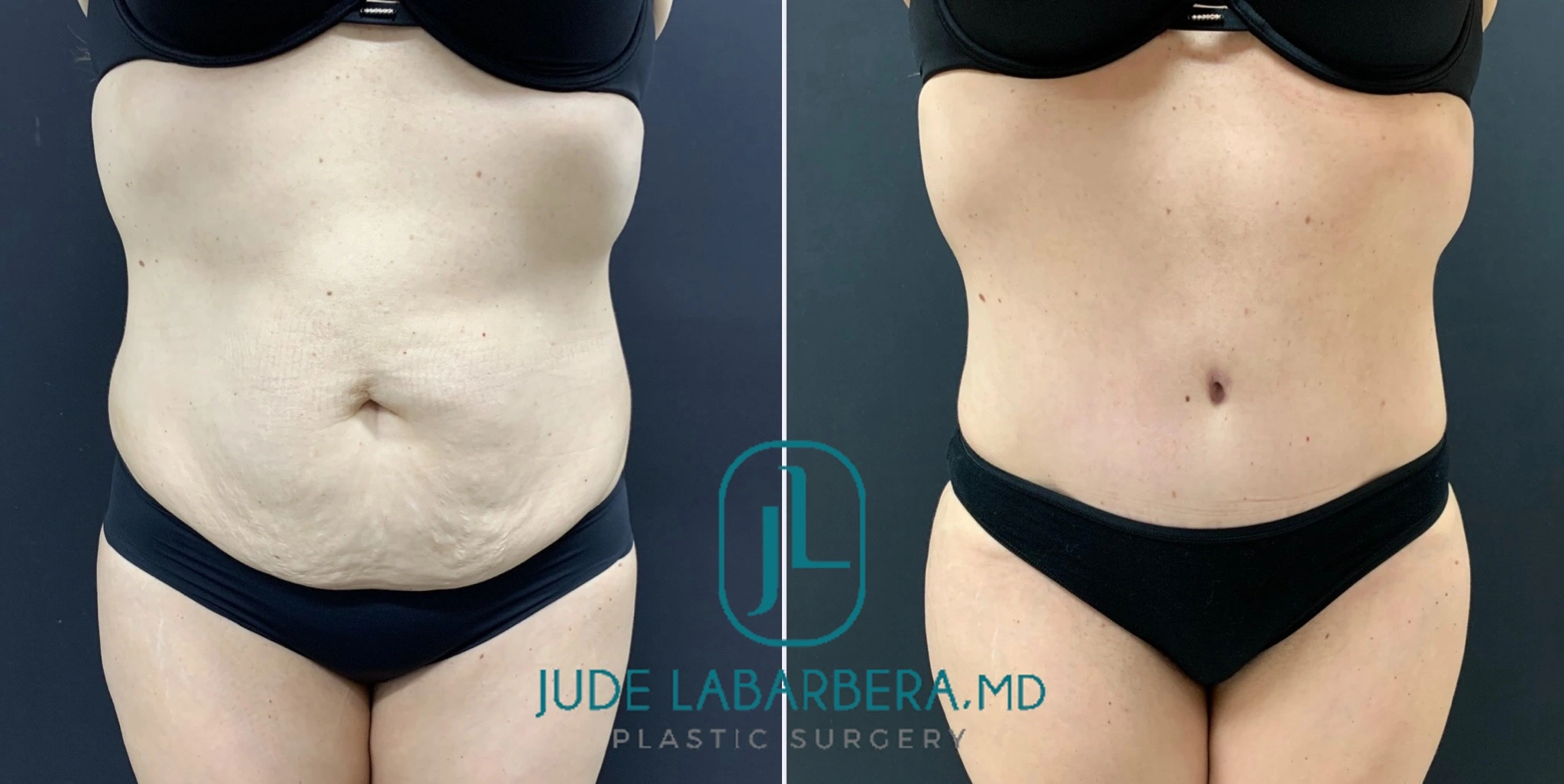 Tummy Tuck Before and after Case Number 000118