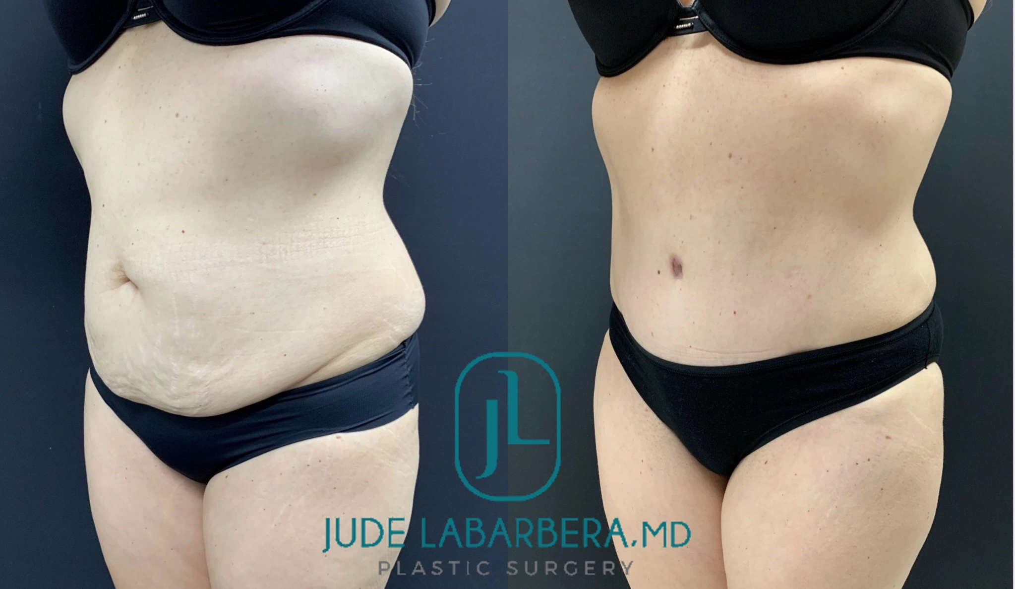 Tummy Tuck Before and after Case Number 000118