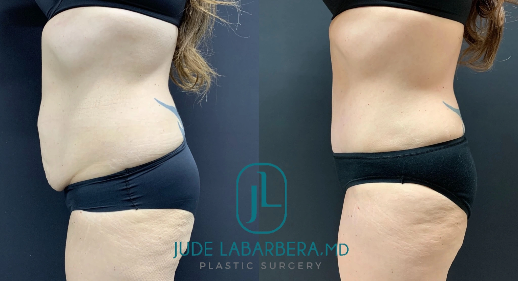 Tummy Tuck Before and after Case Number 000118