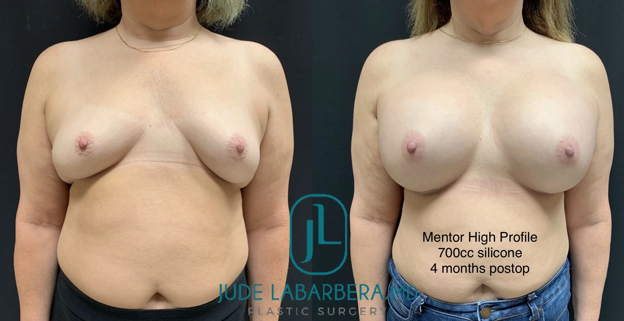 Before and after breast augmentation results, Mentor High Profile 700cc silicone, 4 months postop