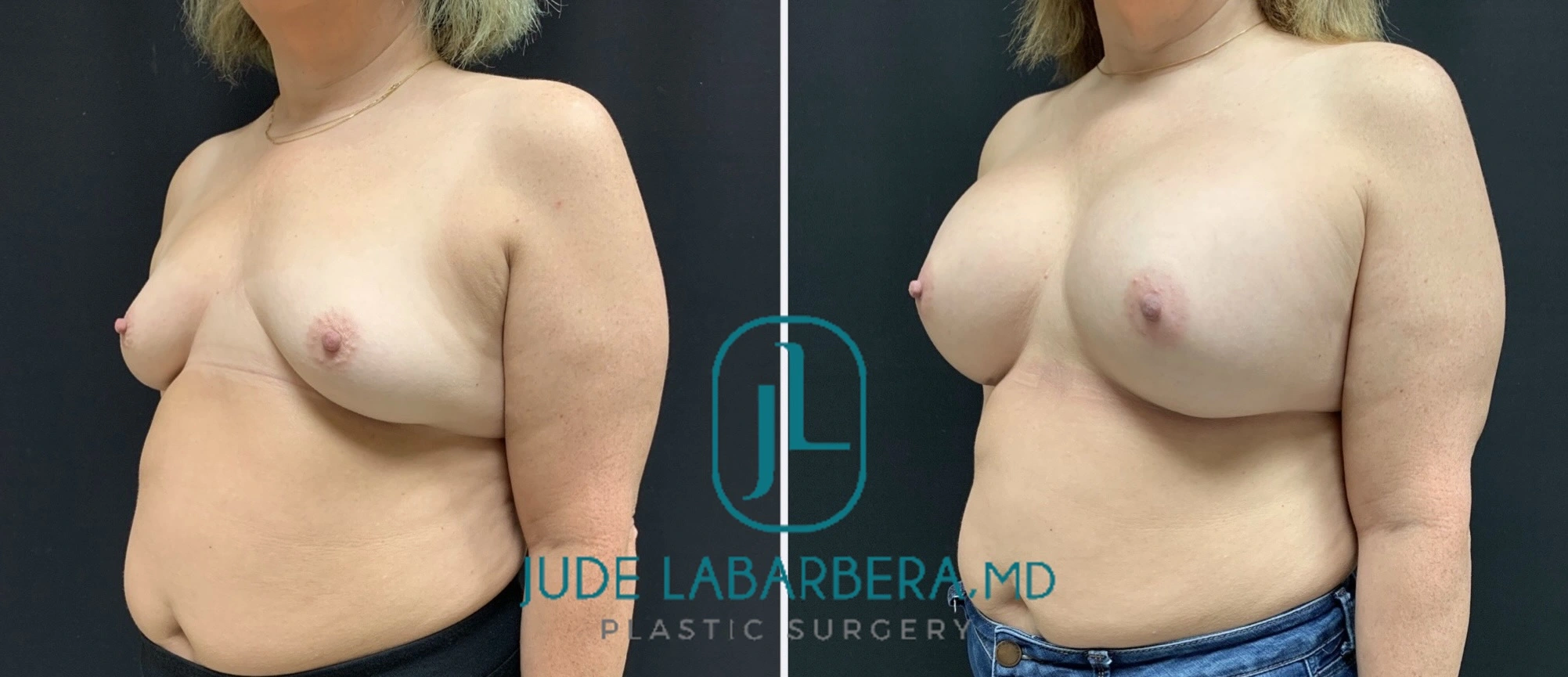 Before and after breast augmentation results from side profile view