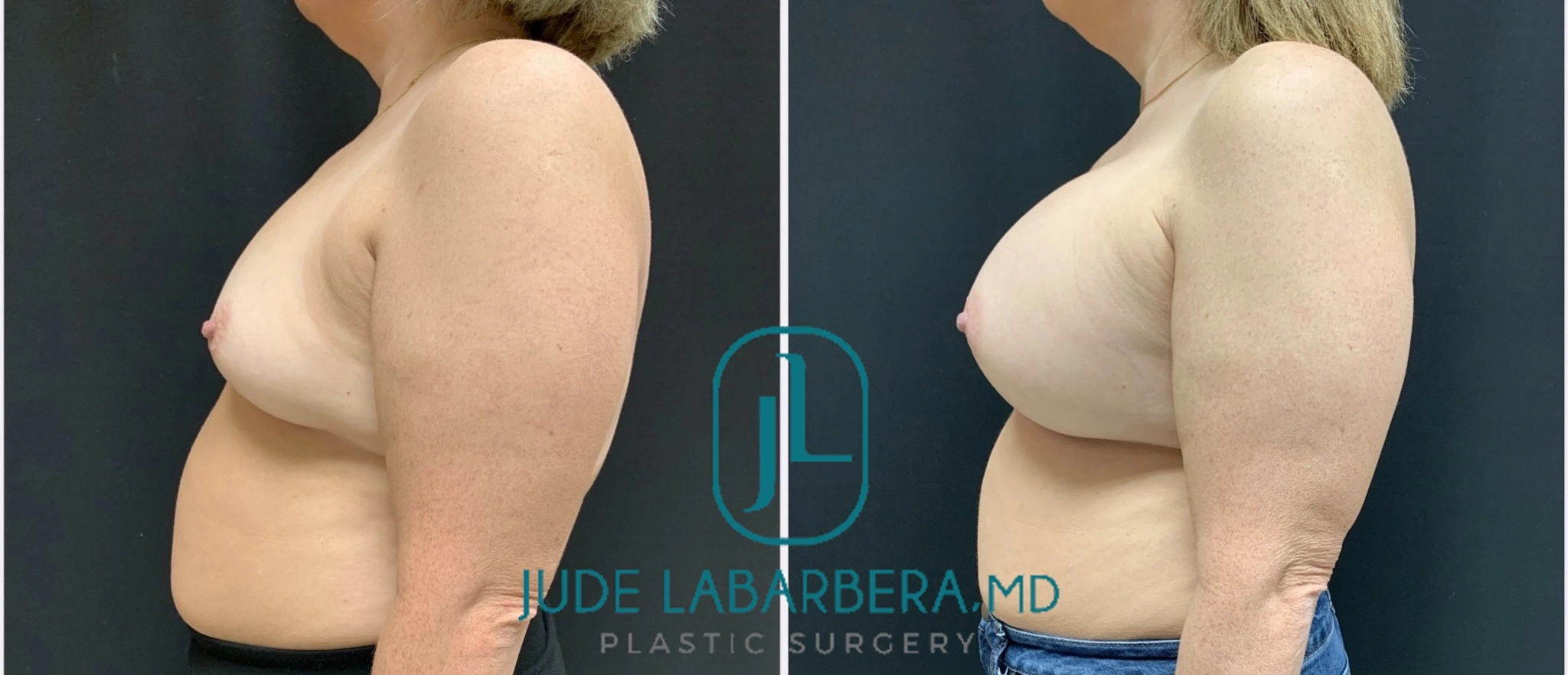 Before and after breast augmentation results from angled profile view