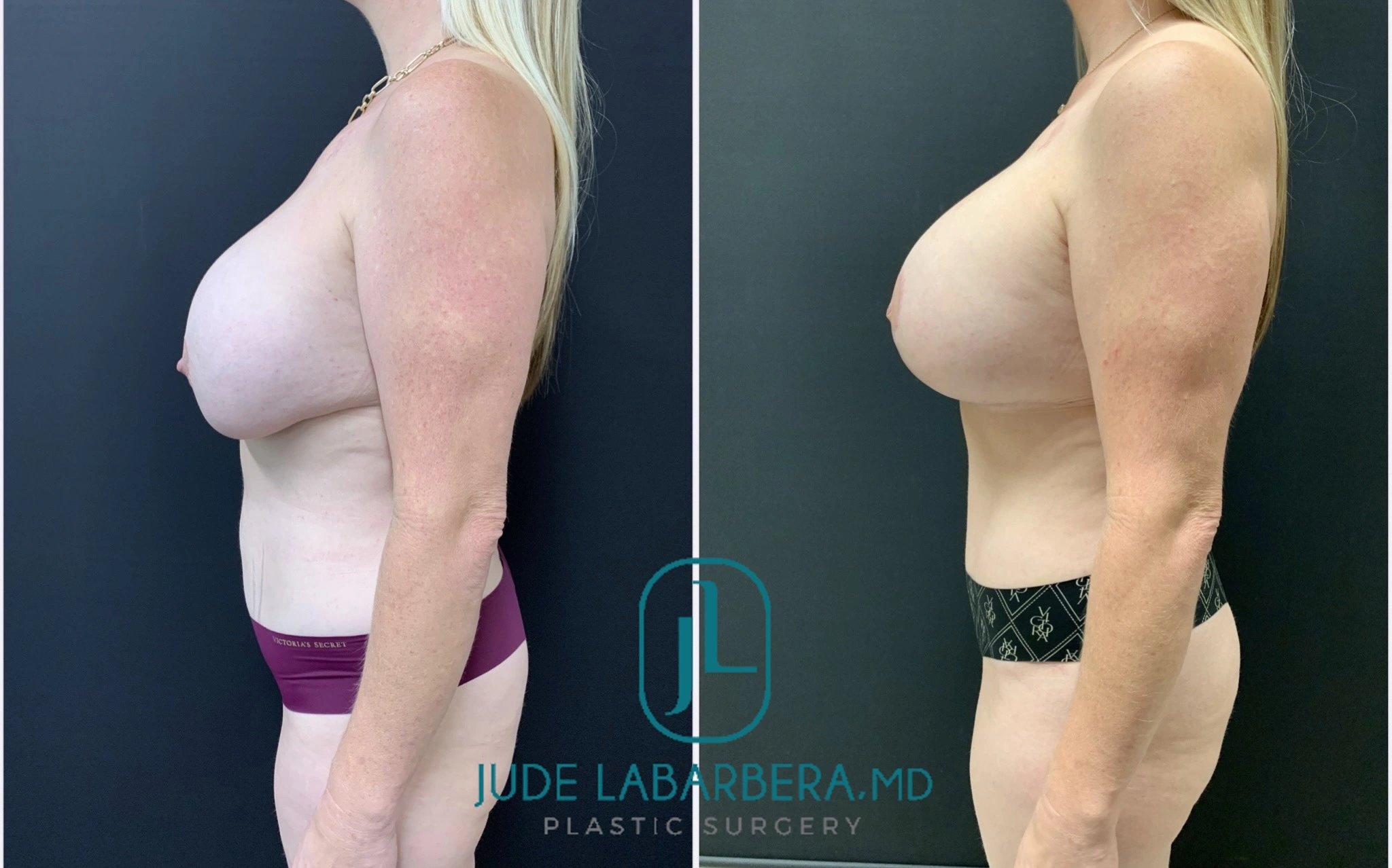 Mommy Makeover before & after Case 006