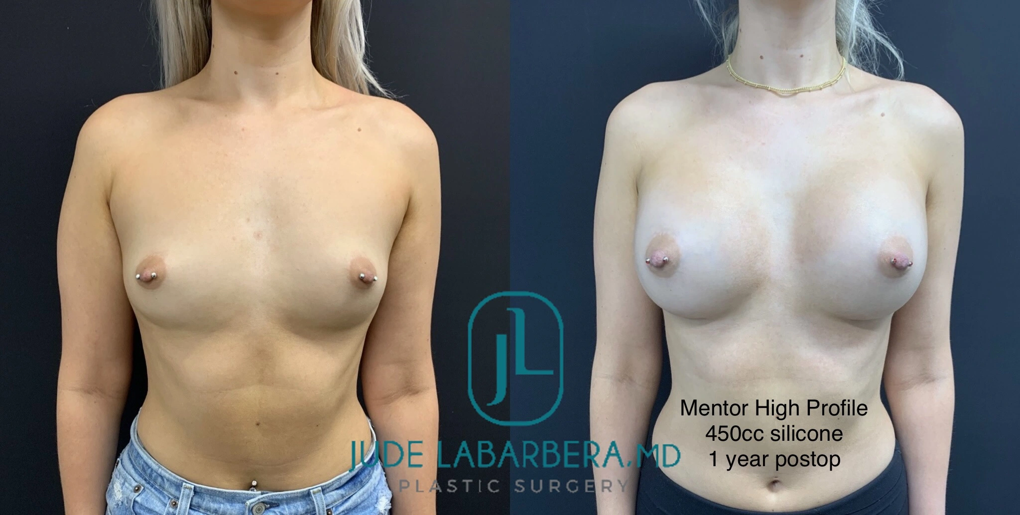 Breast augmentation before and after comparison, patient with Mentor High Profile 450cc silicone implants at 1 year postop