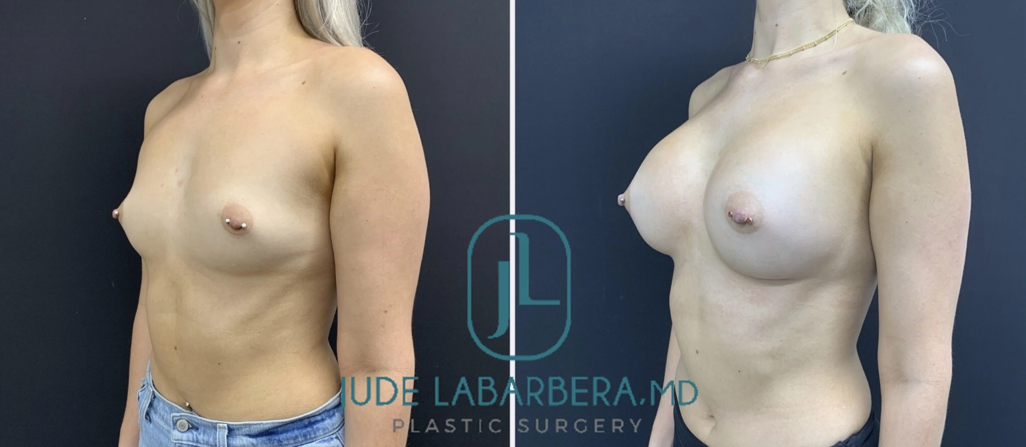 Before and after side profile view of breast augmentation results by Dr. Jude Labarbera