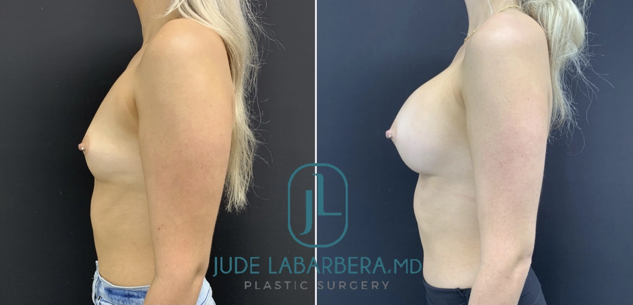 Before and after side profile view of breast augmentation results by Dr. Jude Labarbera