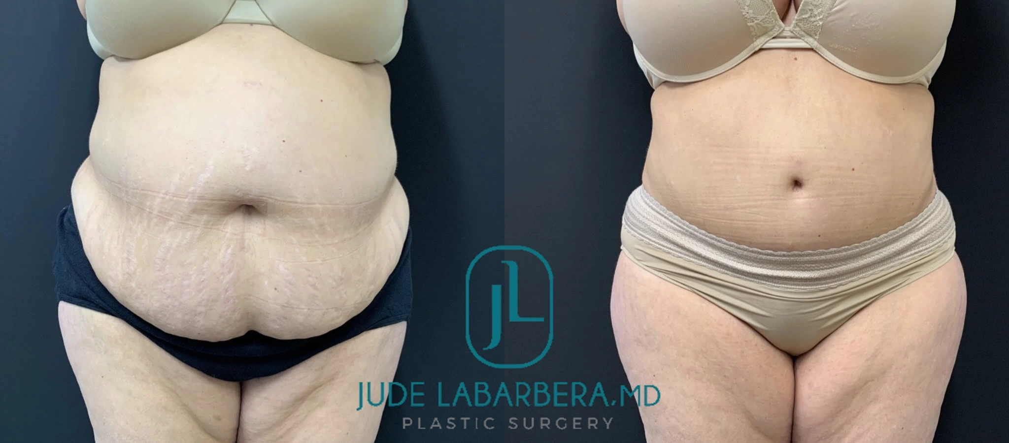 Before and after tummy tuck and body contouring showing abdominal flattening and waist definition
