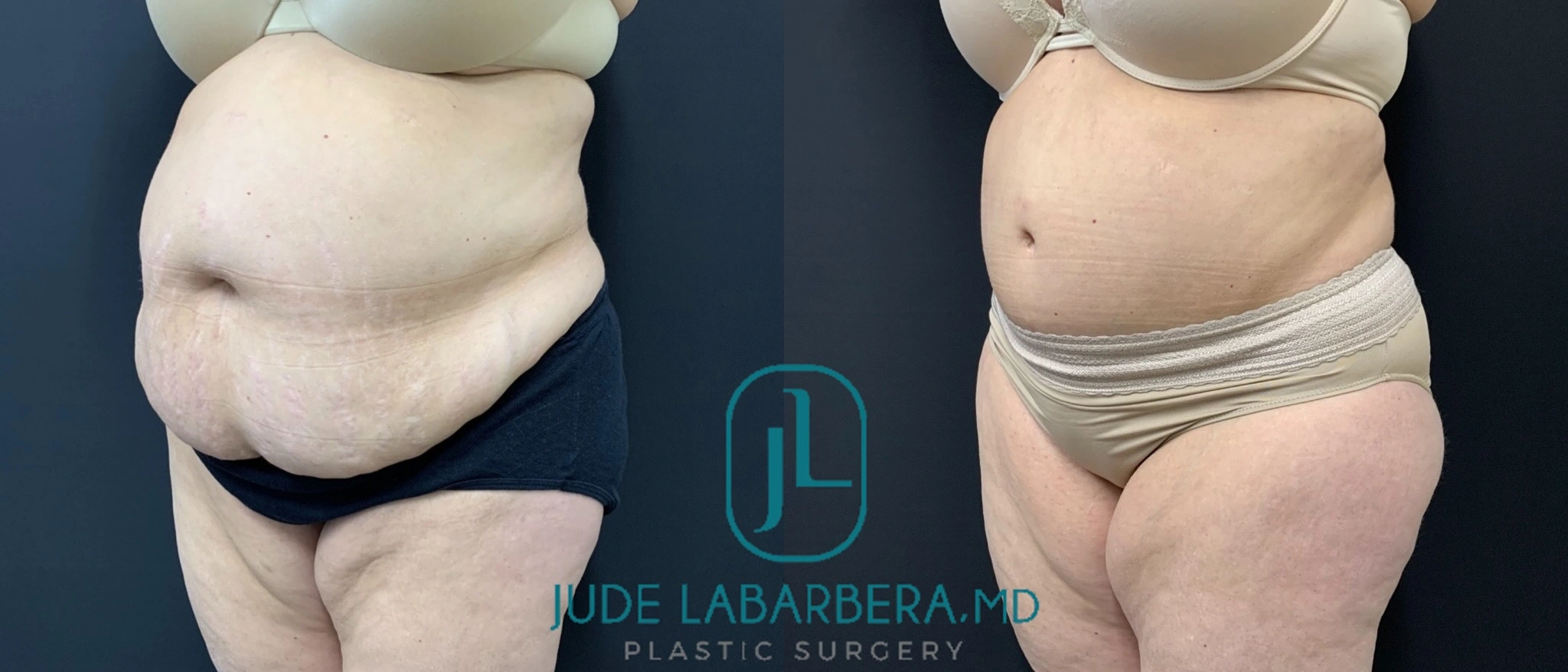 Before and after abdominoplasty results showing frontal view of torso