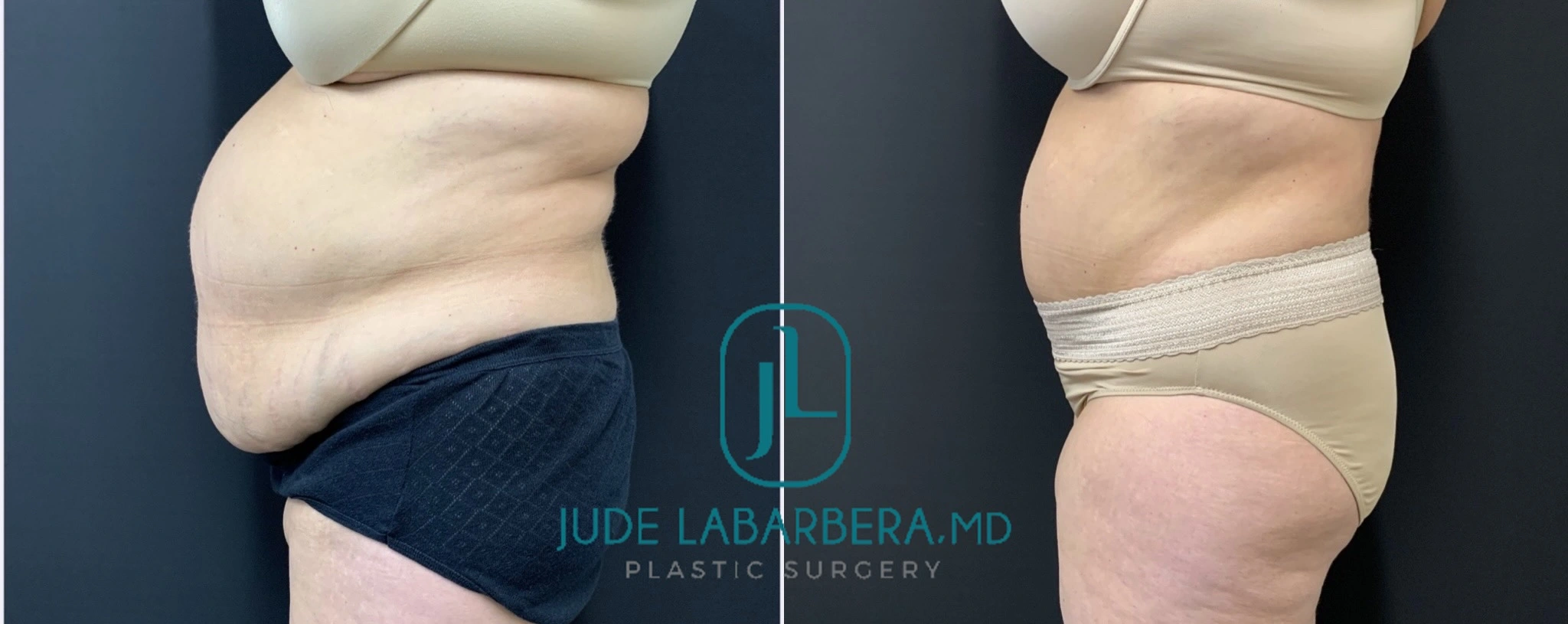 Before and after body contouring results showing side view of torso