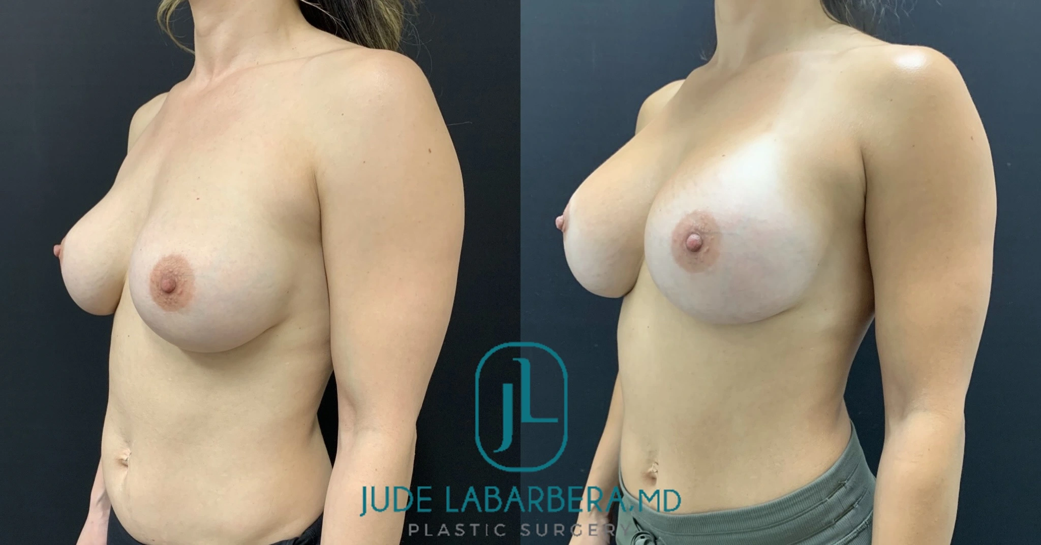 Before and after breast augmentation results by Dr. Jude Labarrera