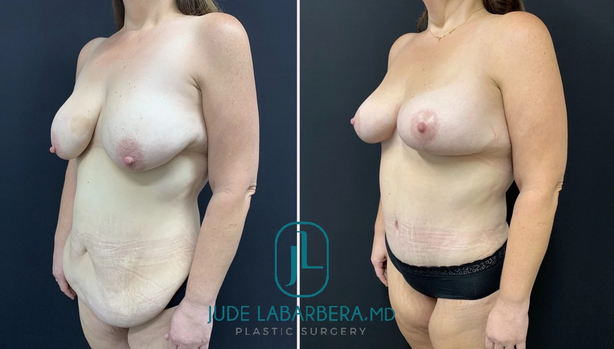 Side view before and after breast lift results showing improved projection and contour