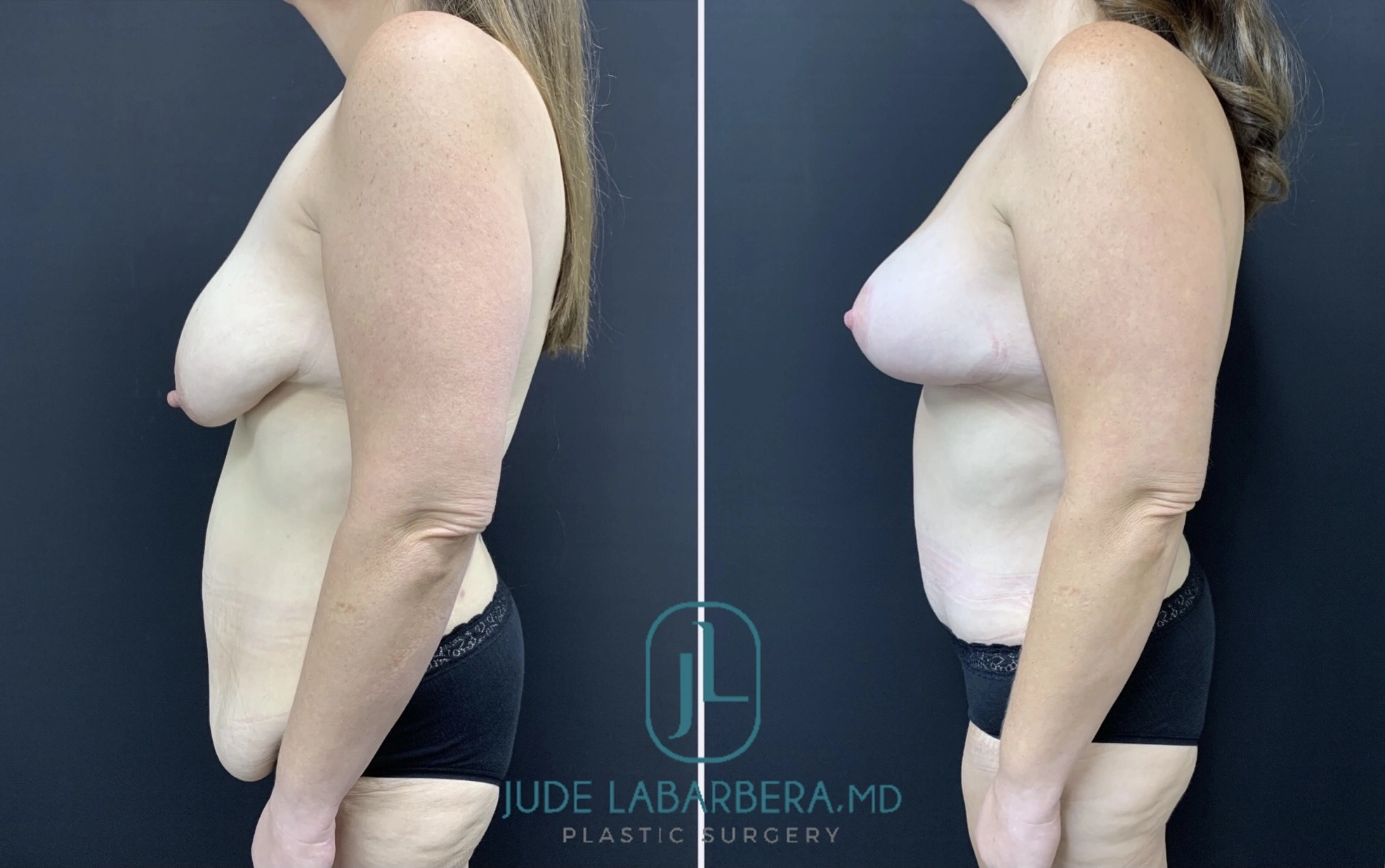 Side profile before and after breast lift results demonstrating improved upper pole fullness