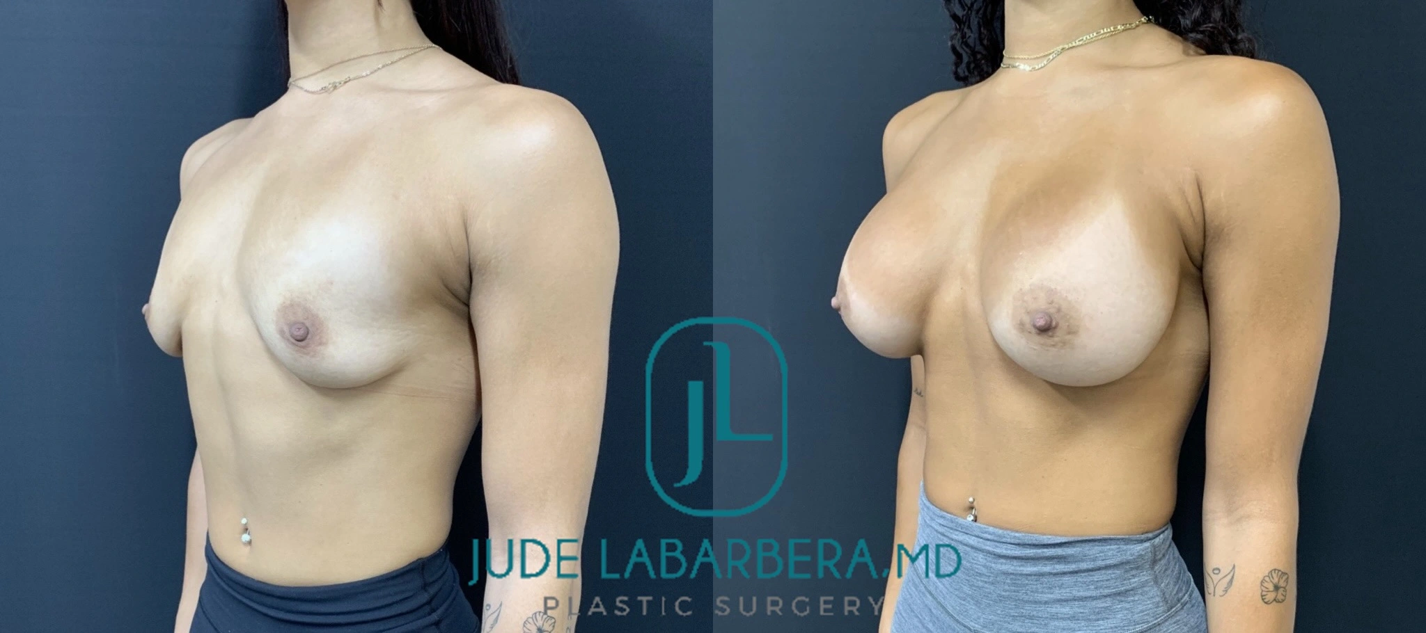 Before and after breast augmentation showing increased volume and improved breast shape, frontal view