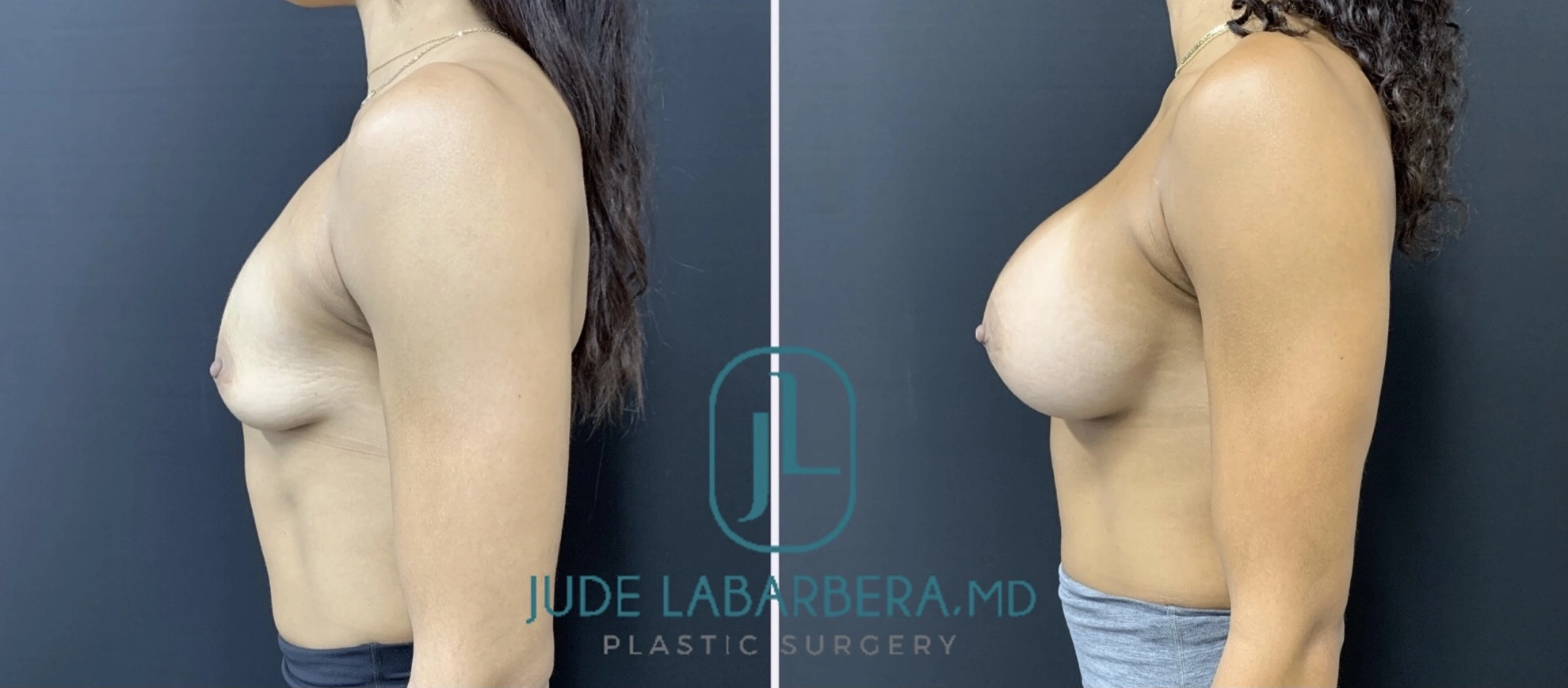 Before and after breast augmentation showing enhanced projection and contour, side profile view