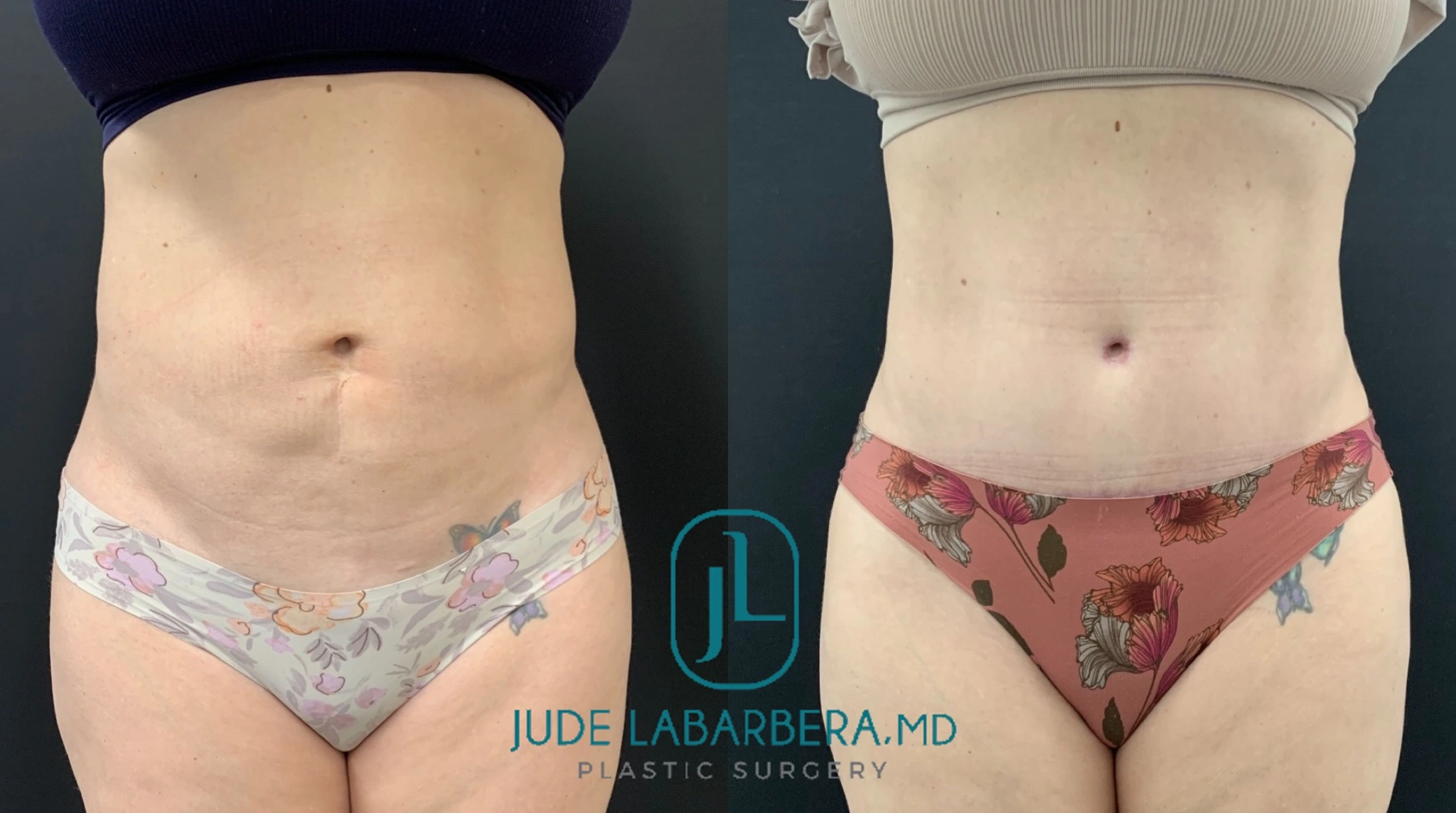 Before and after abdominoplasty, front view showing reduced abdominal contour and improved waistline