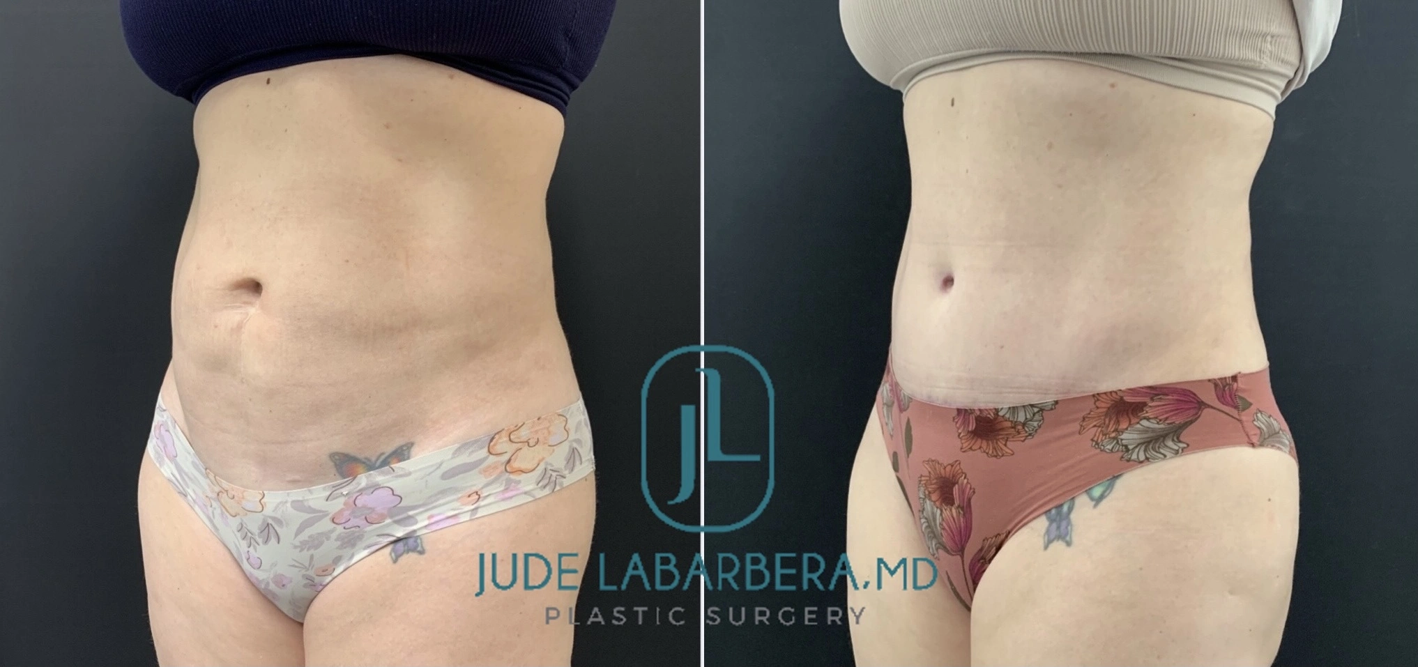 Liposuction before and after comparison, front view