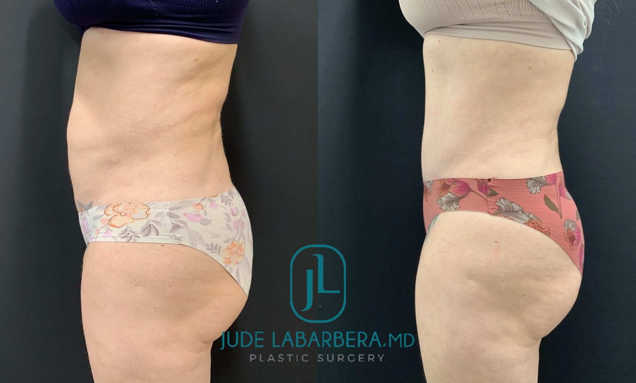 Liposuction before and after comparison, side view