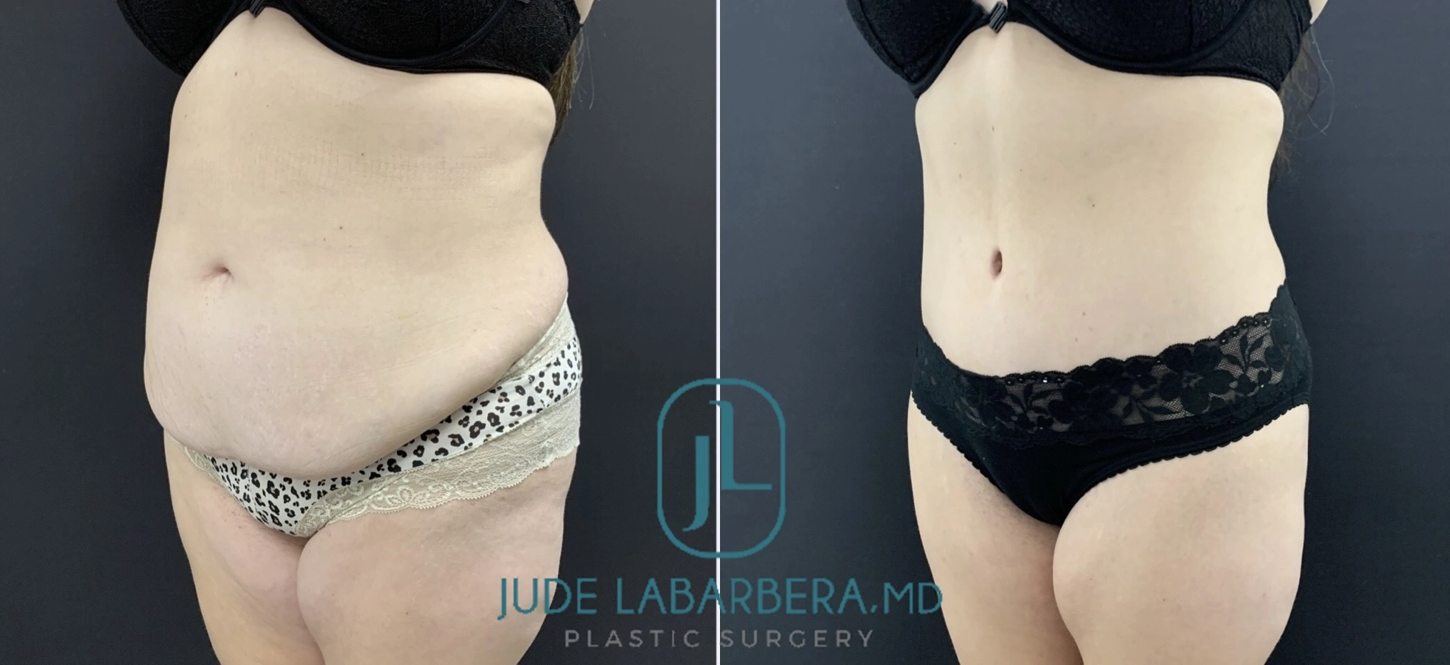 Before and after abdominal liposuction, showing reduced midsection and improved body contour