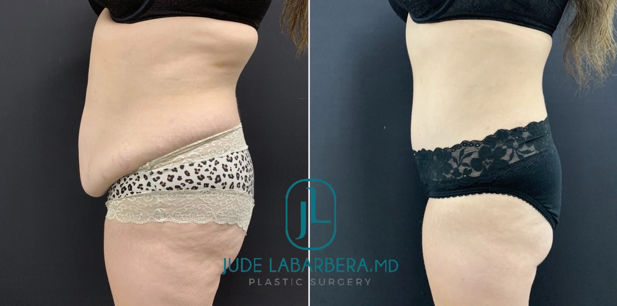 Before and after liposuction, side view showing reduced abdominal and flank fullness