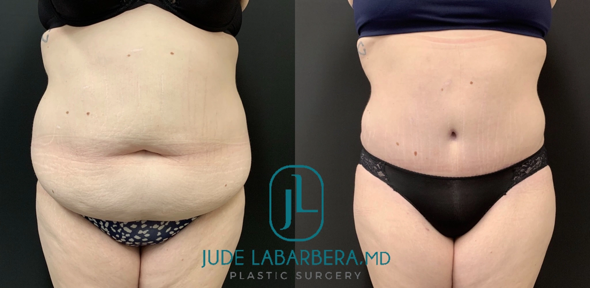 Before and after liposuction, front view showing flatter abdomen
