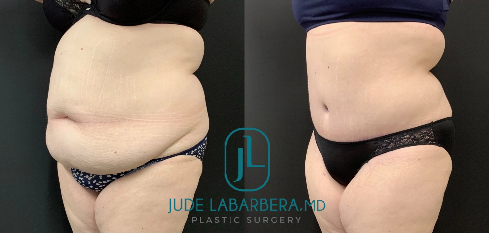 Before and after liposuction, side view showing slimmer midsection