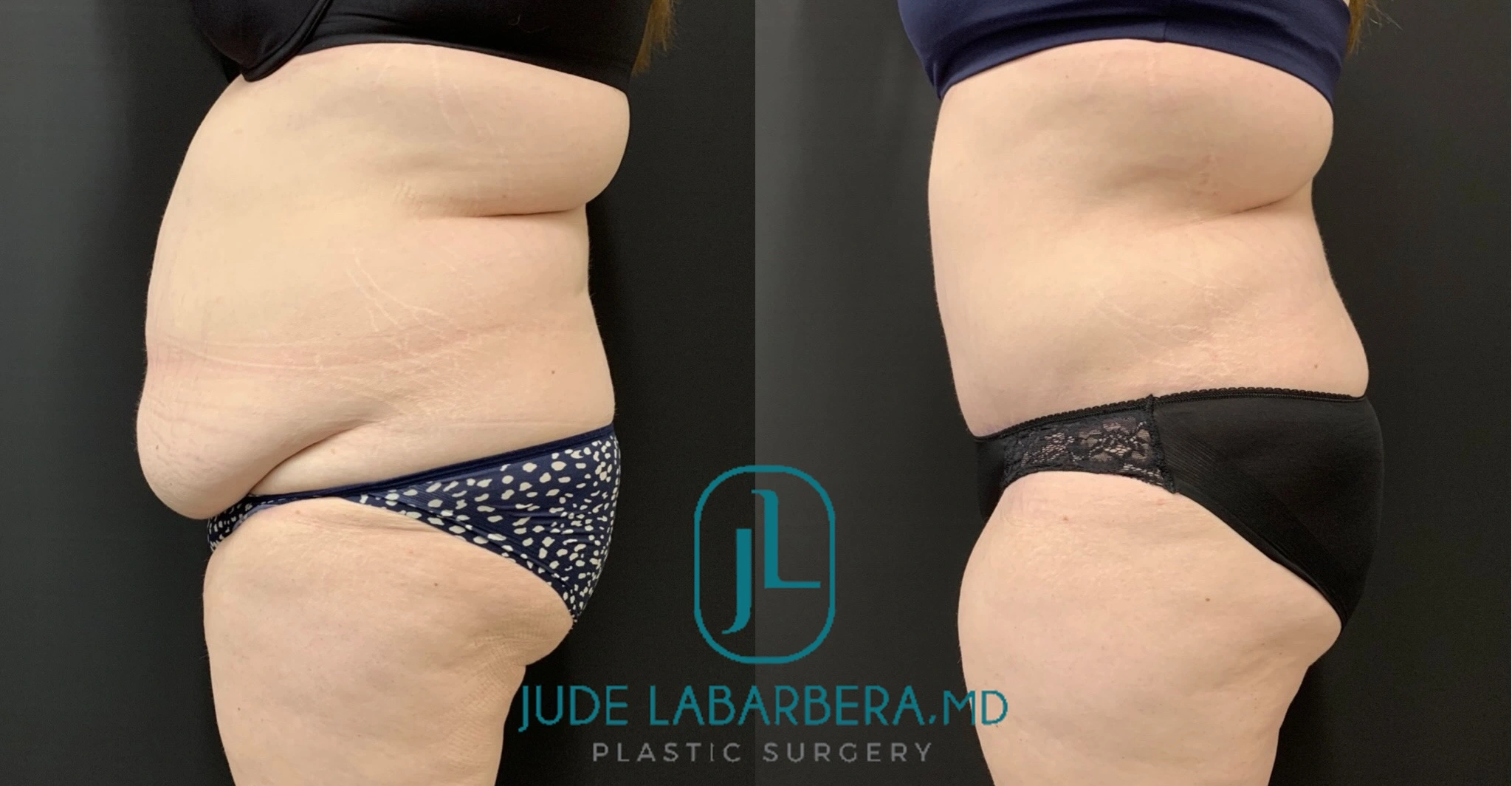 Before and after liposuction, side view showing reduced flank and abdominal fullness