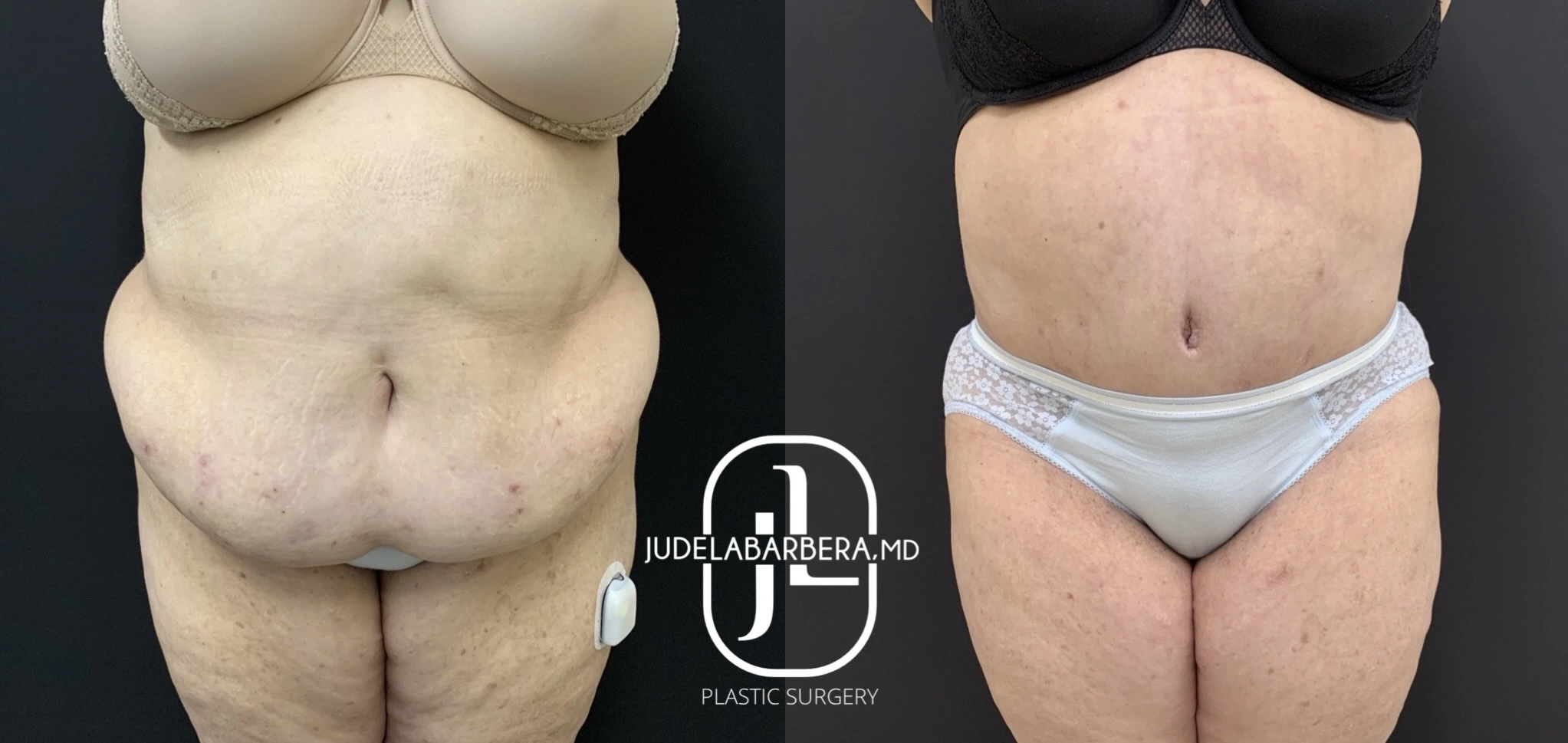 Before and after tummy tuck surgery by Dr. Jude Labarrera, front view comparison