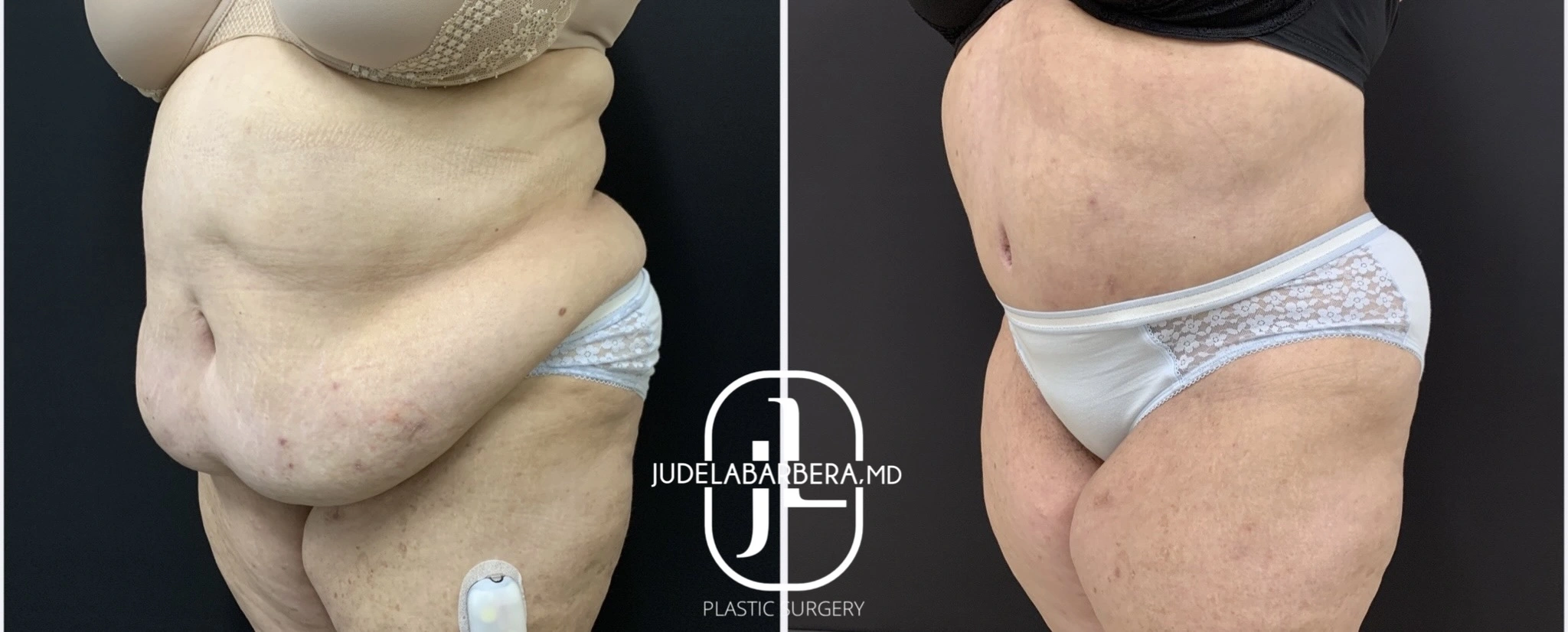 Before and after tummy tuck surgery by Dr. Jude Labarrera, side view comparison