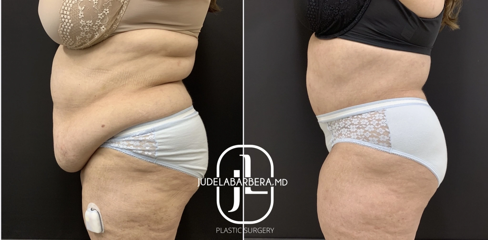 Before and after tummy tuck and body contouring by Dr. Jude Labarrera, side view