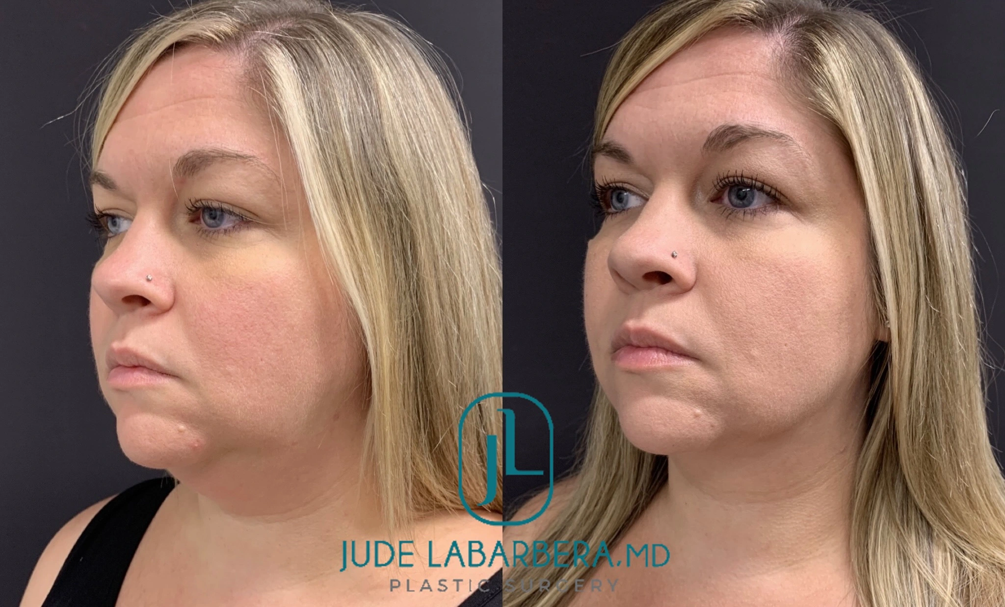 Before and after profile views showing improved facial contours and chin projection