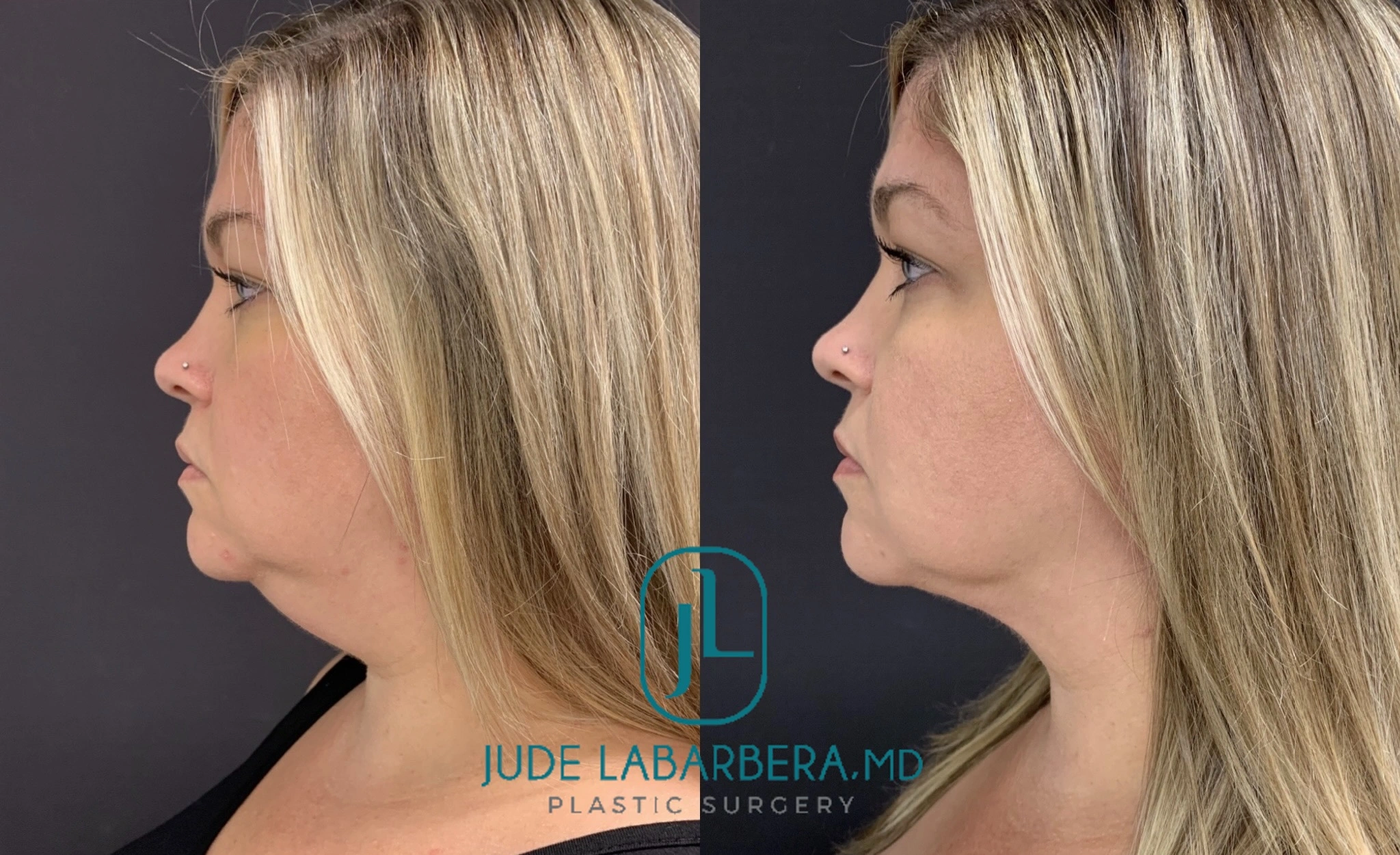 Before and after profile views showing refined chin and jawline definition from side angle