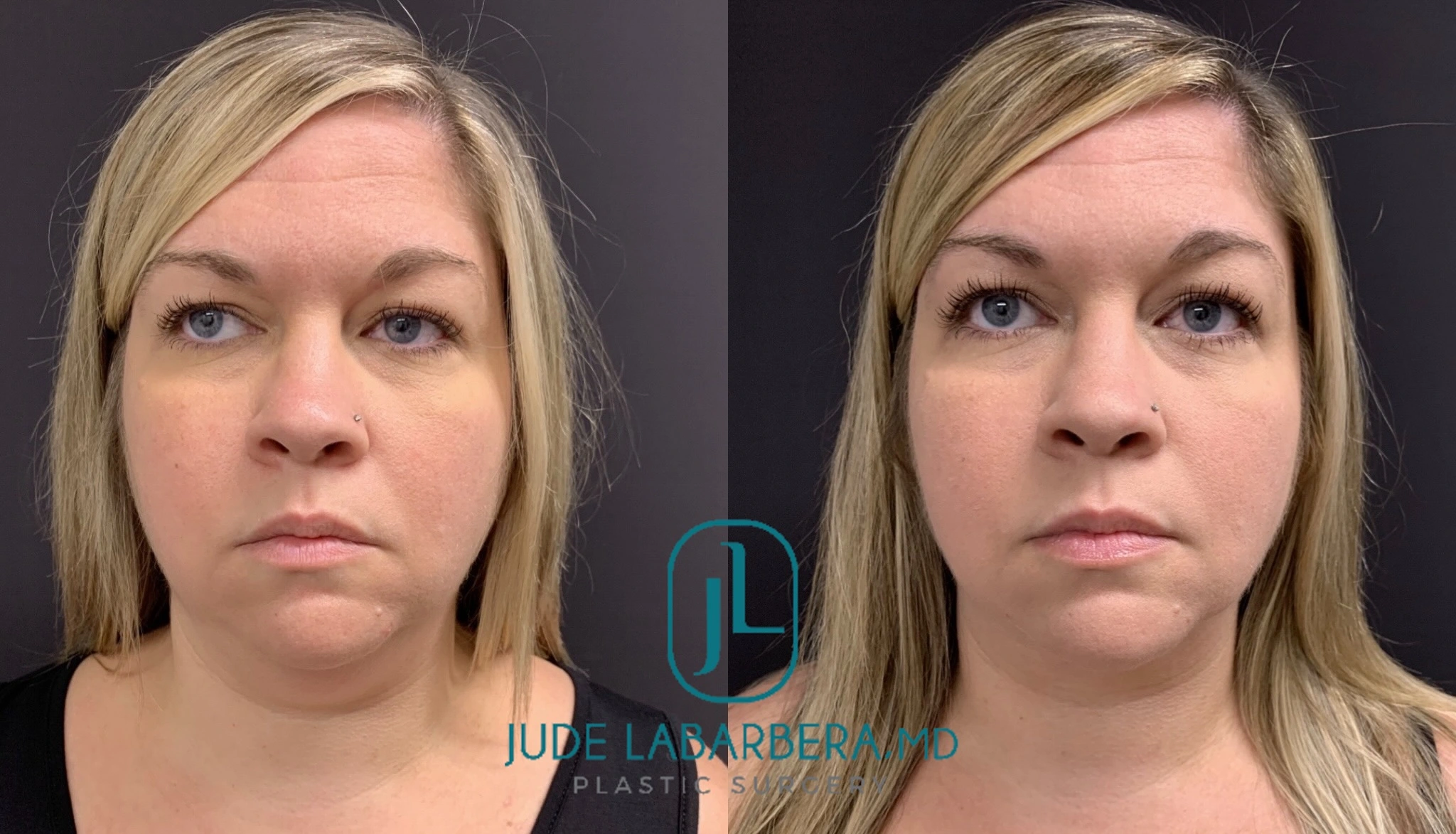 Before and after frontal facial views showing refined cheekbones and overall facial balance