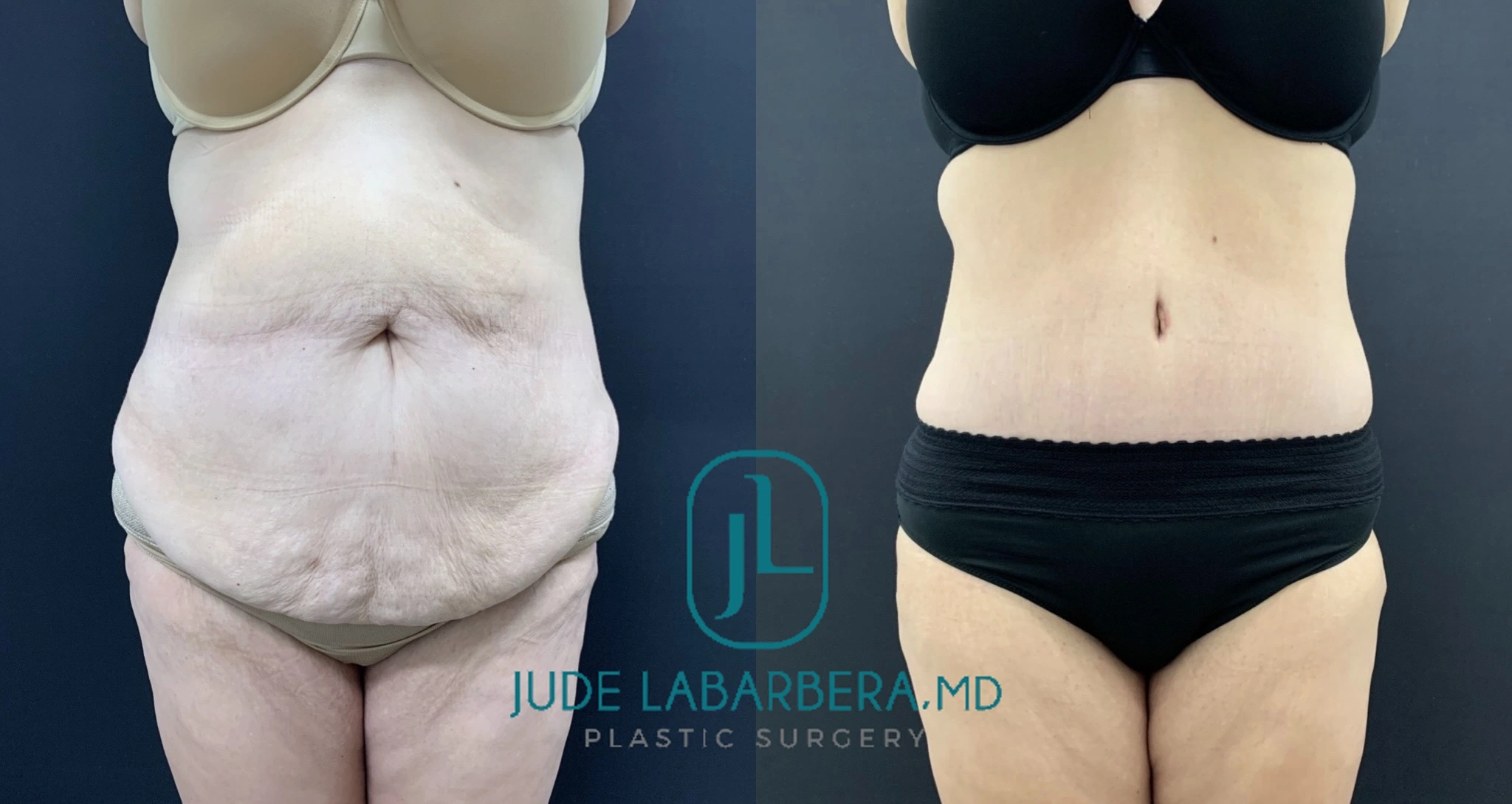 Before and after frontal lower body view showing reduced lower abdominal and thigh contours