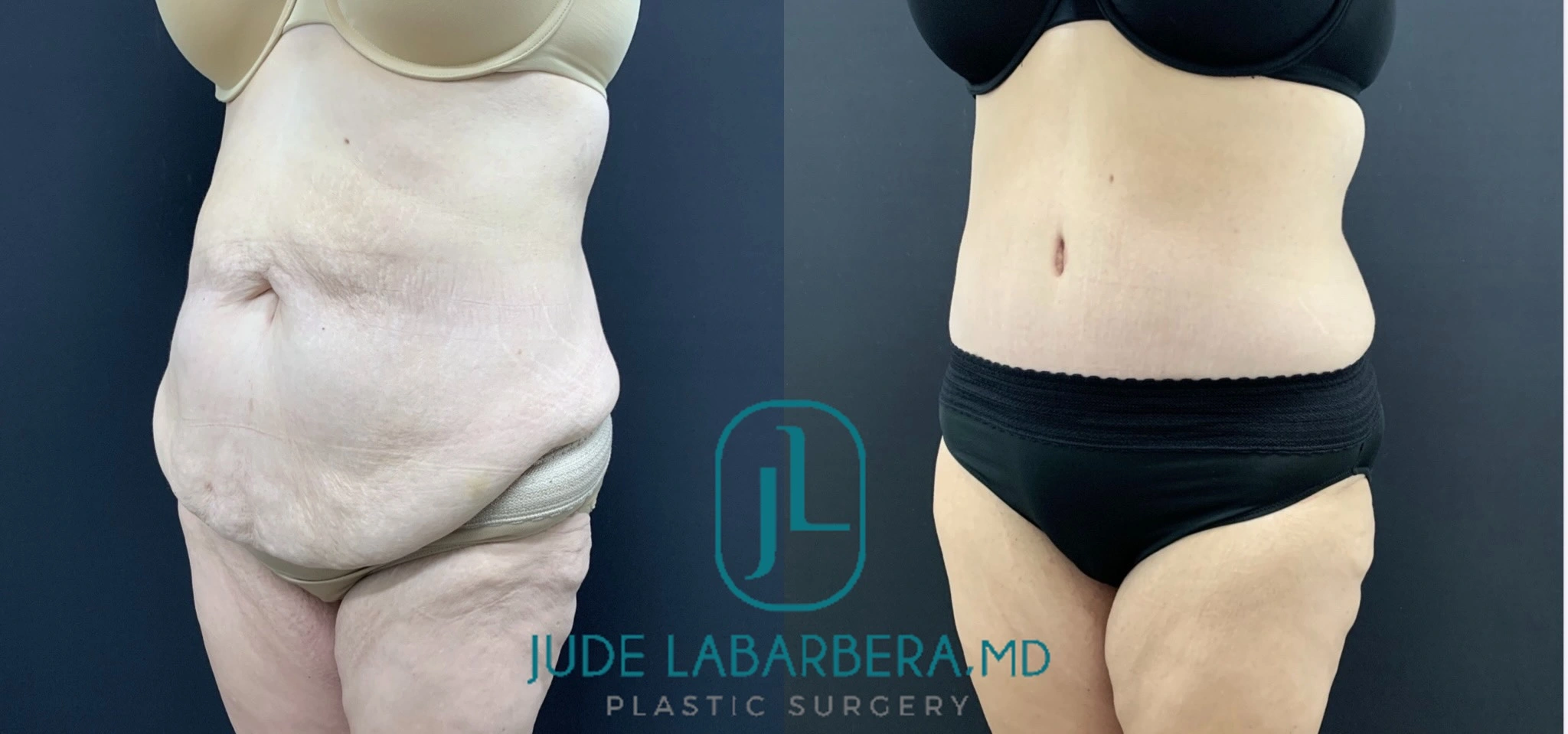 Before and after frontal view of torso showing reduced midsection and flatter abdominal appearance