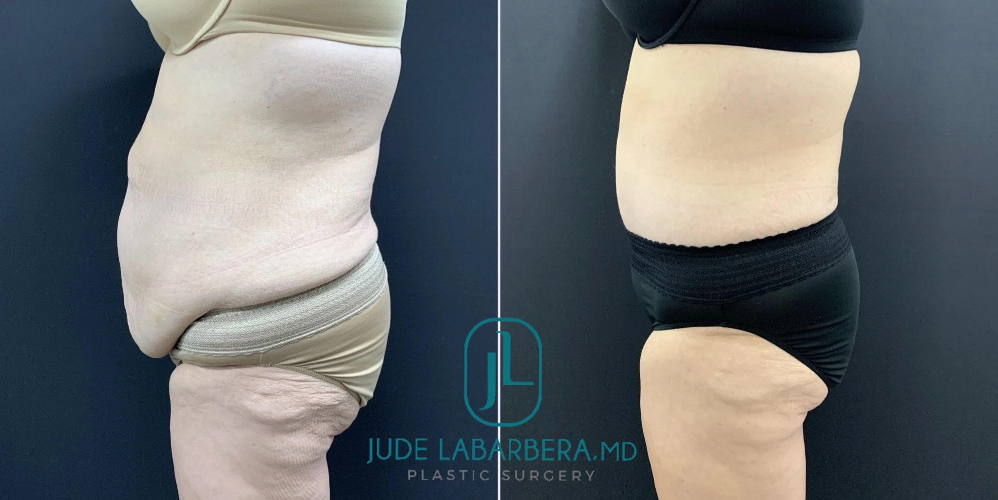Before and after side view of abdomen showing reduced abdominal fullness and improved contour