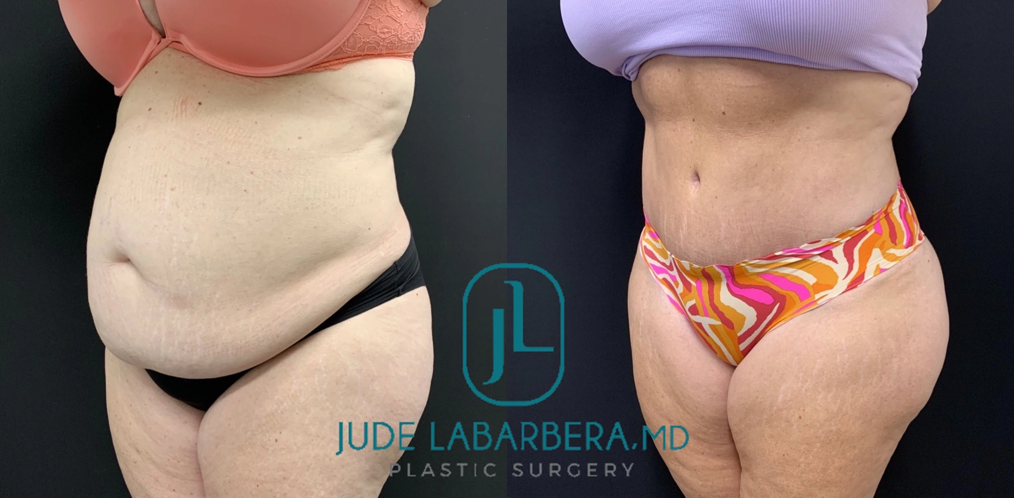 tummy-tuck-before-after-case-number-00084-b