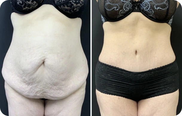 About Extended Tummy Tuck Banner