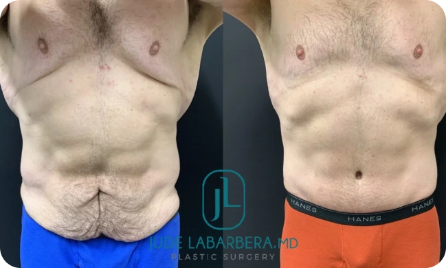 About Tummy Tuck After Weight Loss Banner