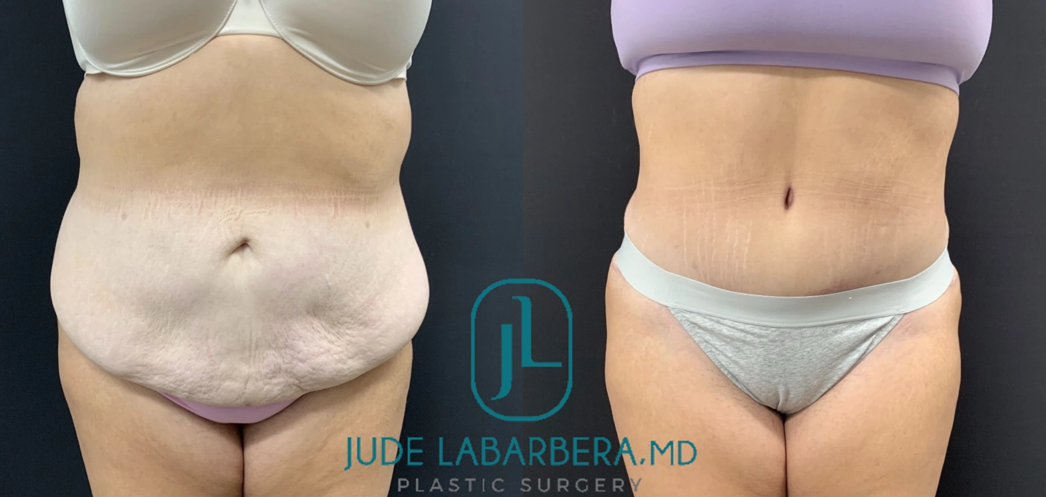 Before and after abdominal contouring results from front angle